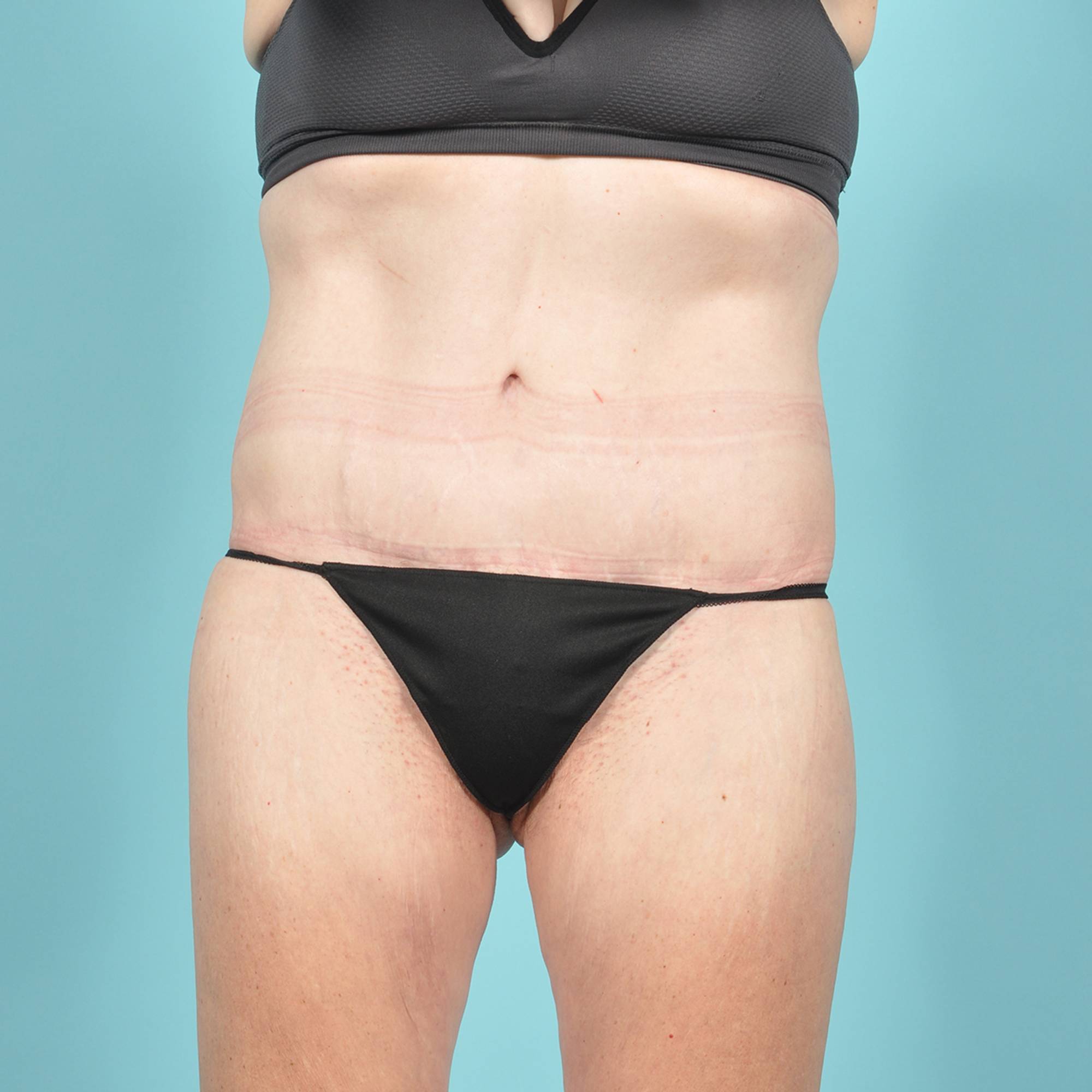 Tummy Tuck Before & After Image