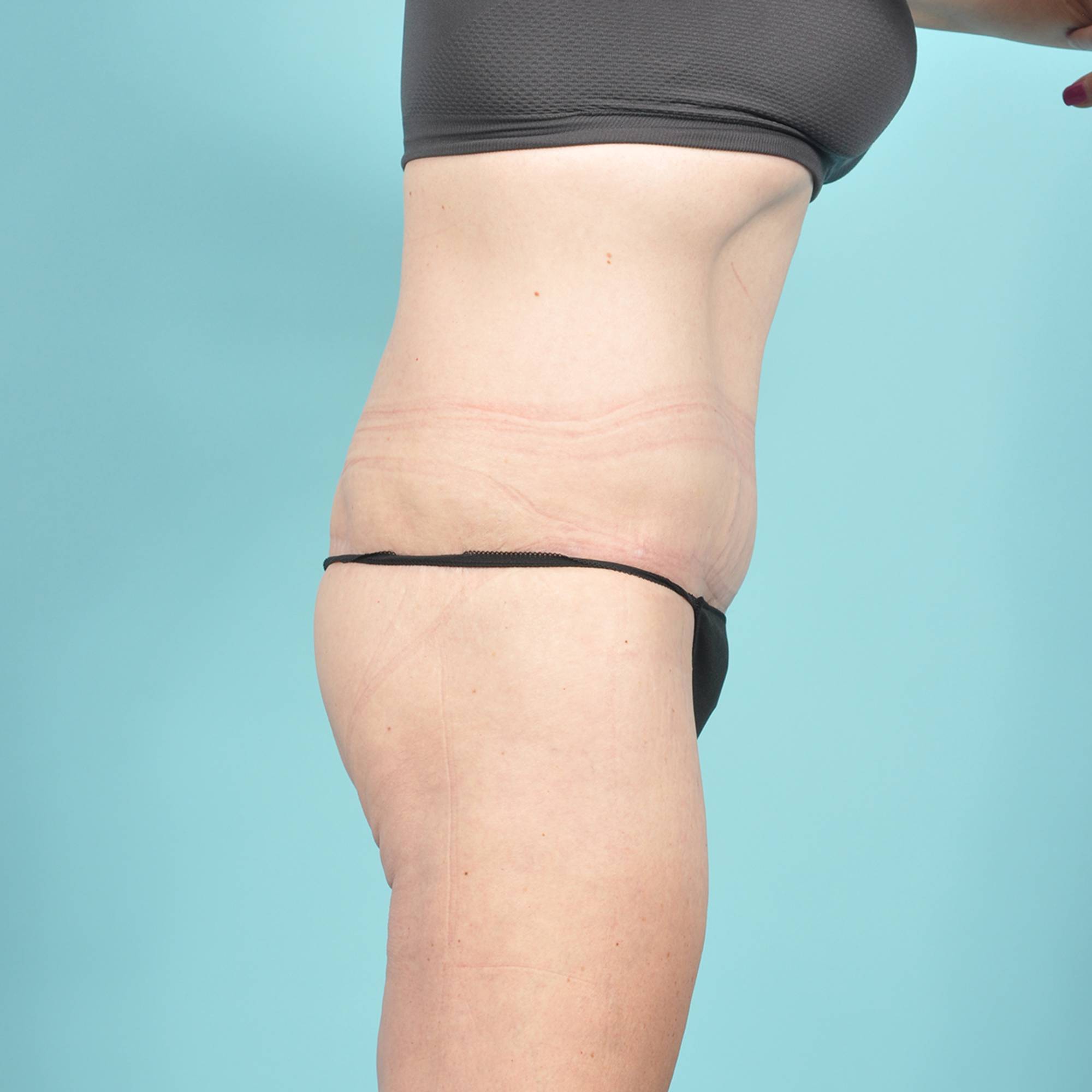 Tummy Tuck Before & After Image