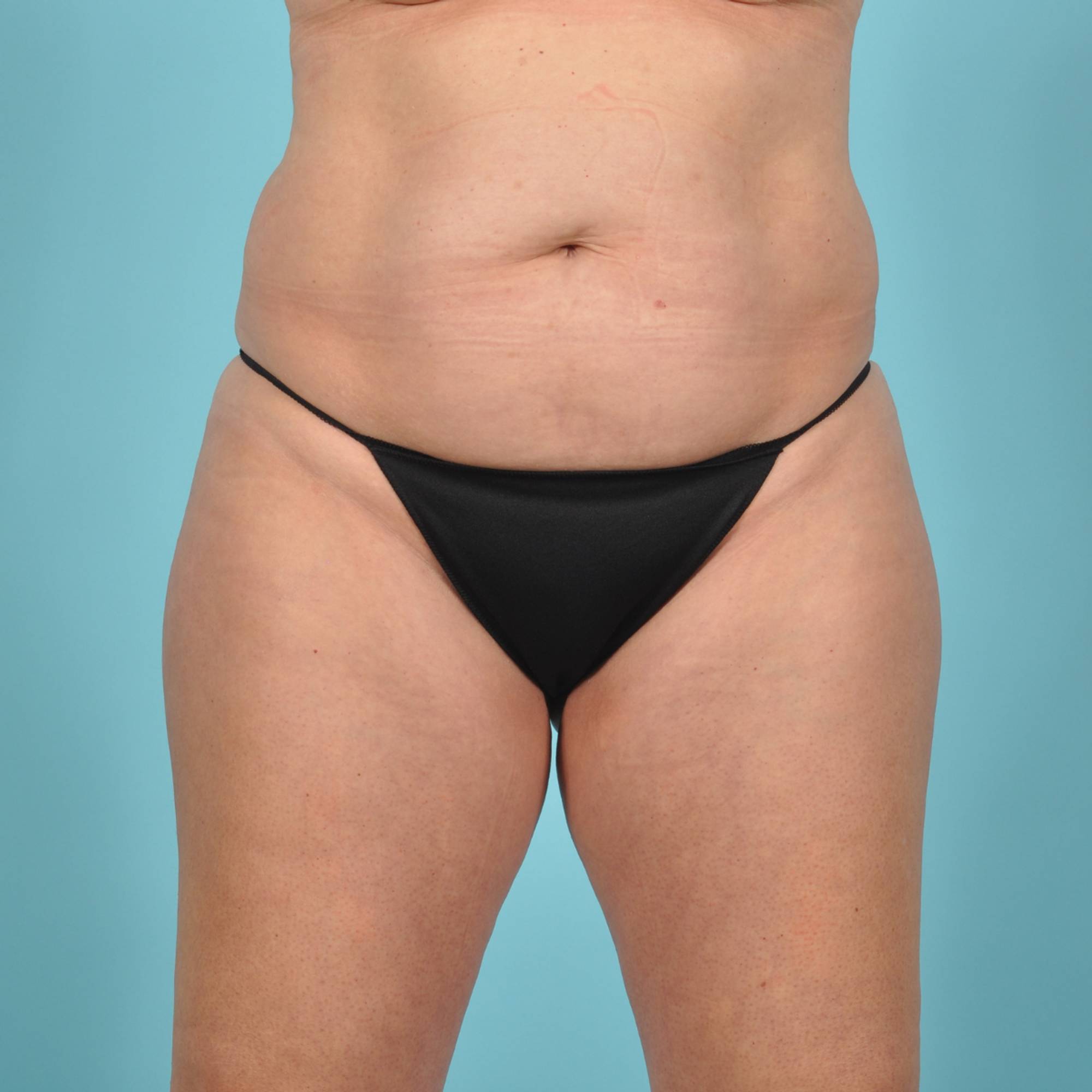 Tummy Tuck Before & After Image
