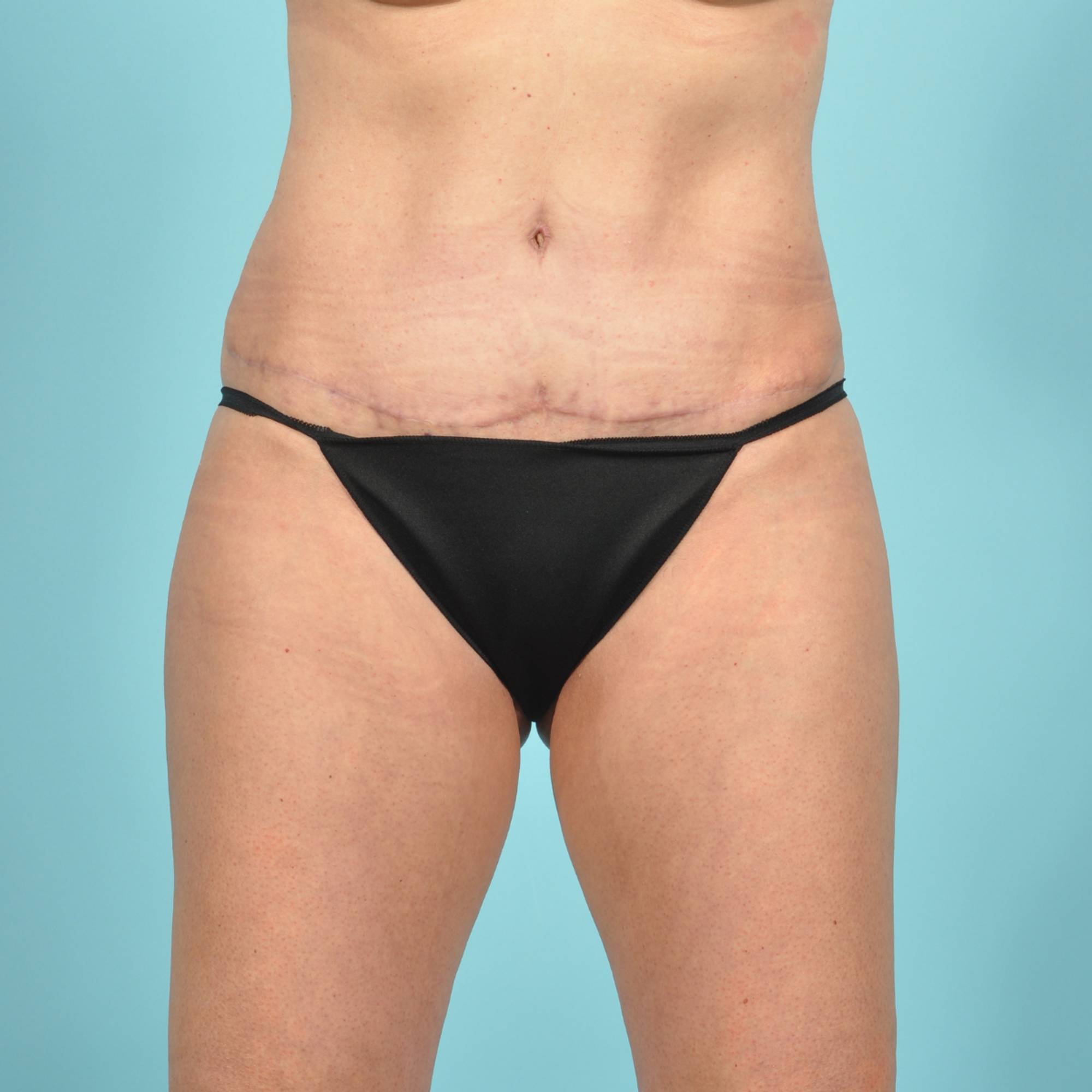 Tummy Tuck Before & After Image