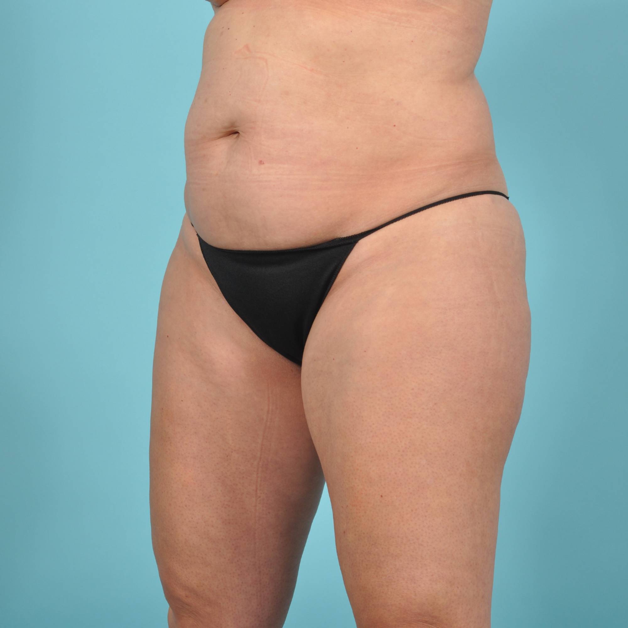 Tummy Tuck Before & After Image
