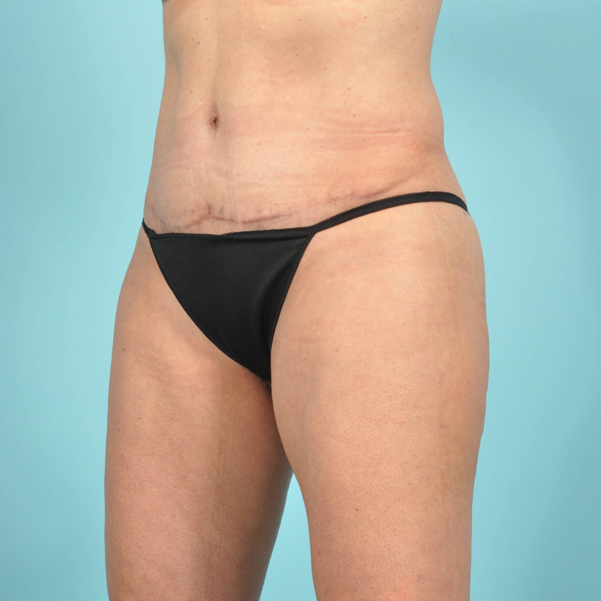 Tummy Tuck Before & After Image