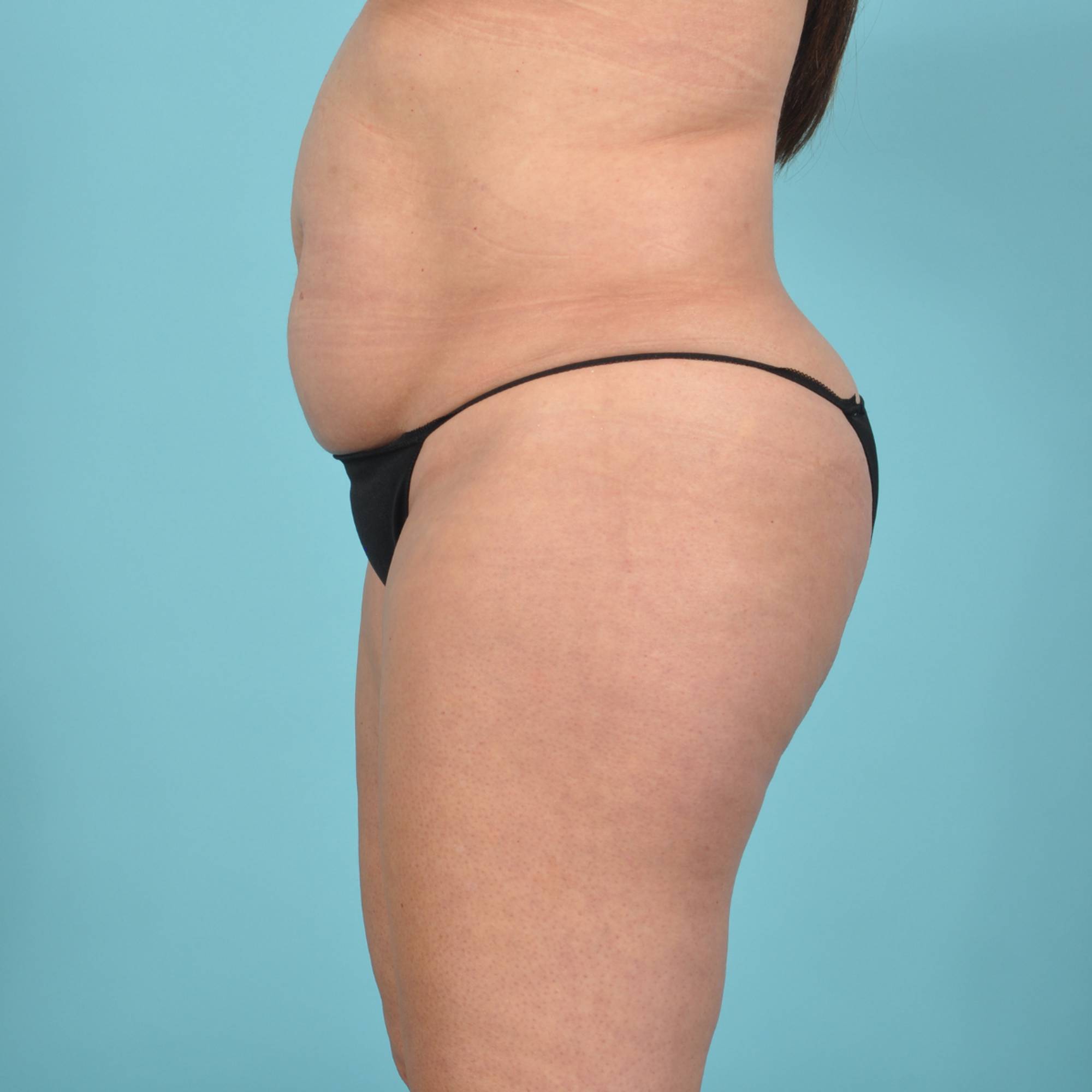 Tummy Tuck Before & After Image