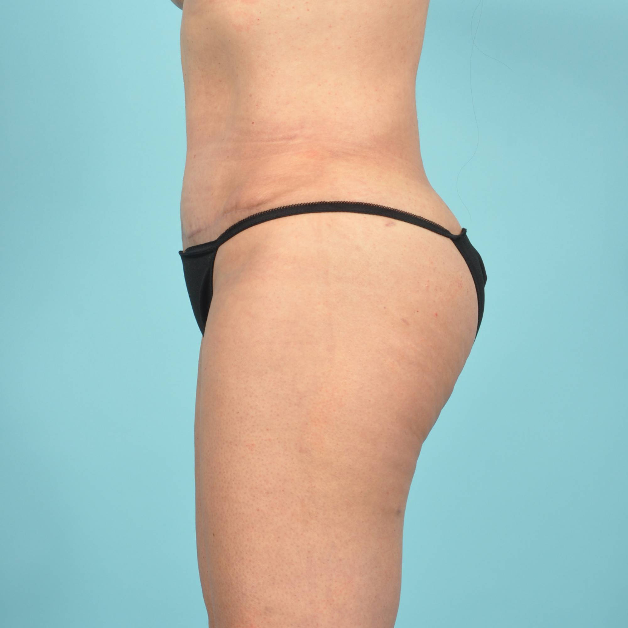 Tummy Tuck Before & After Image