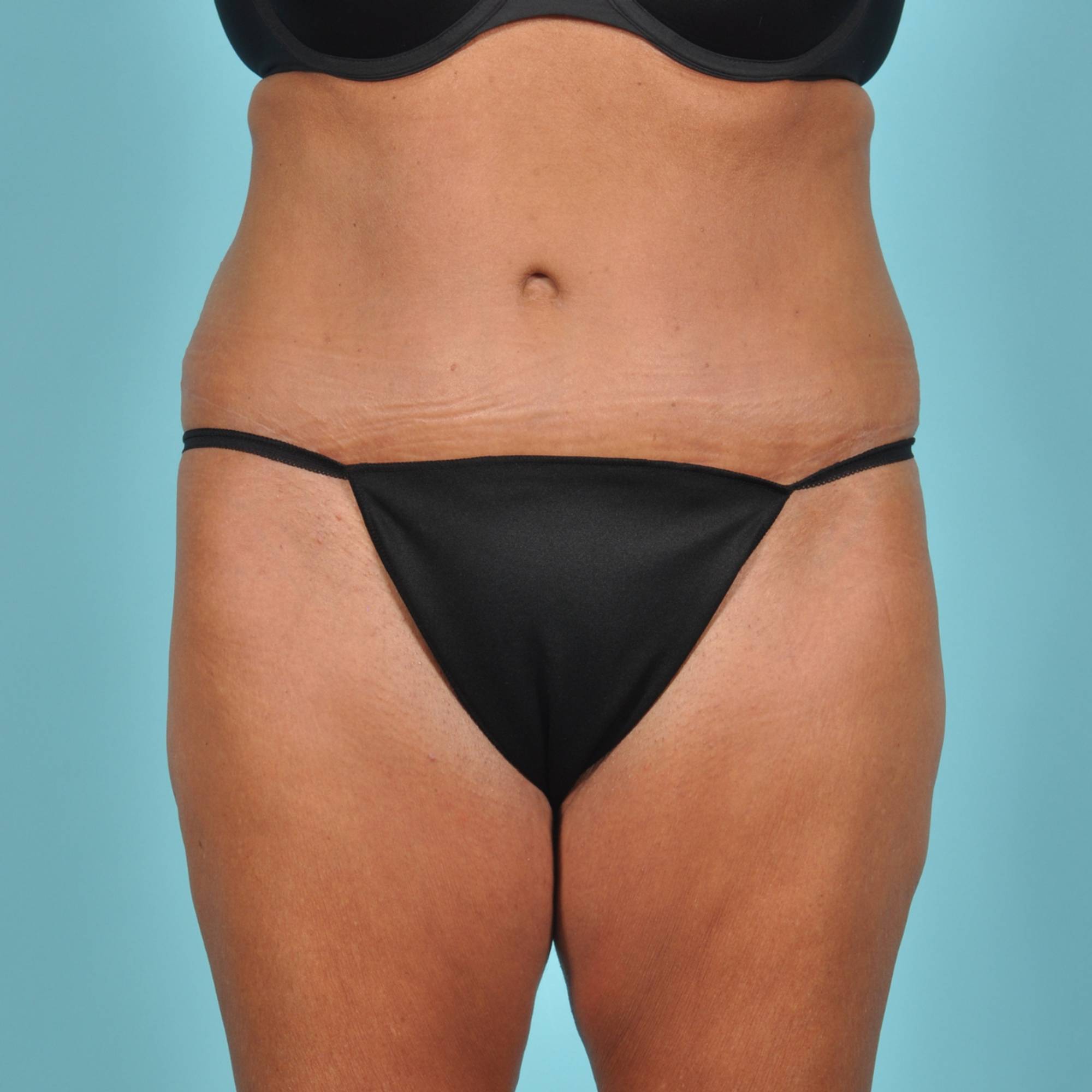 Tummy Tuck Before & After Image