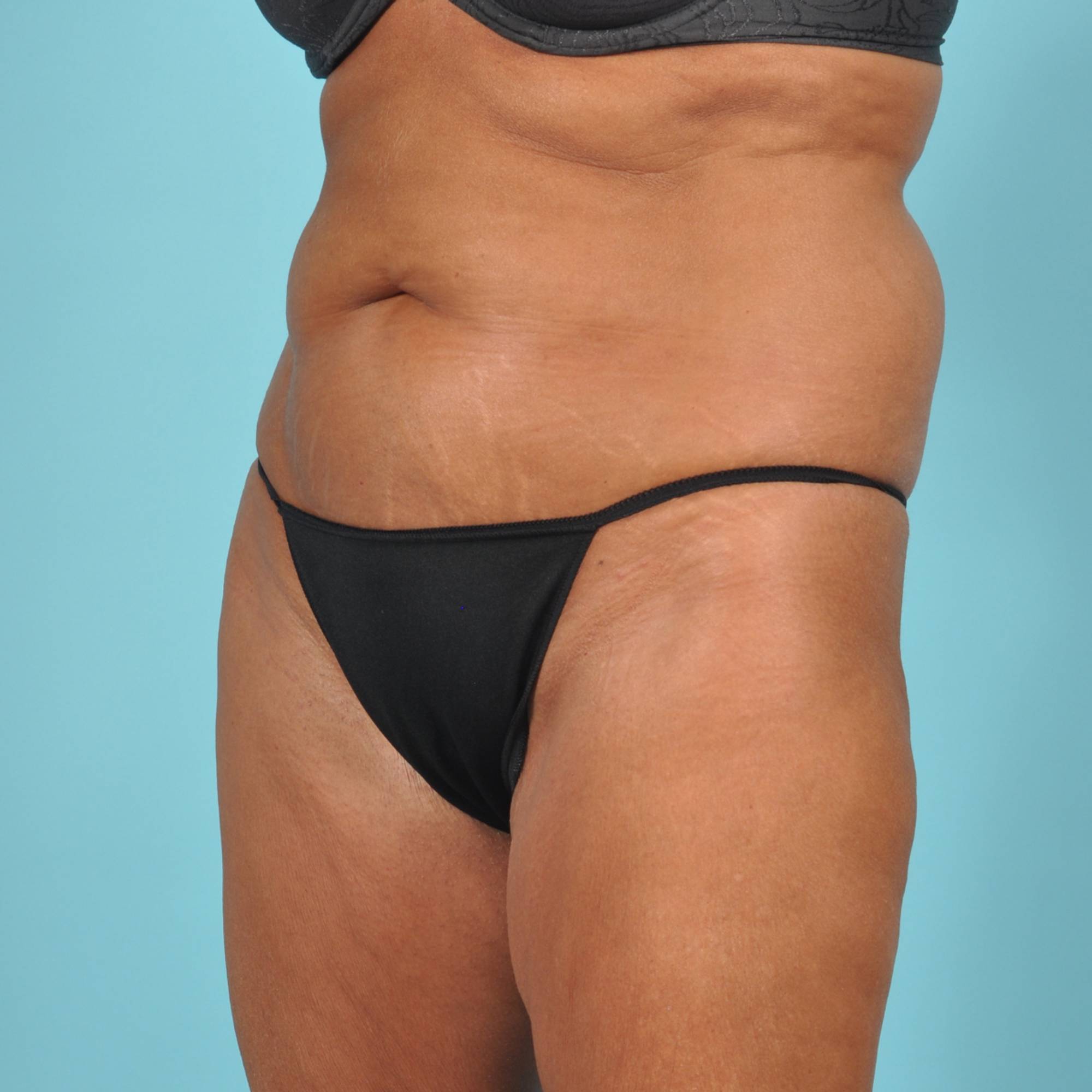 Tummy Tuck Before & After Image