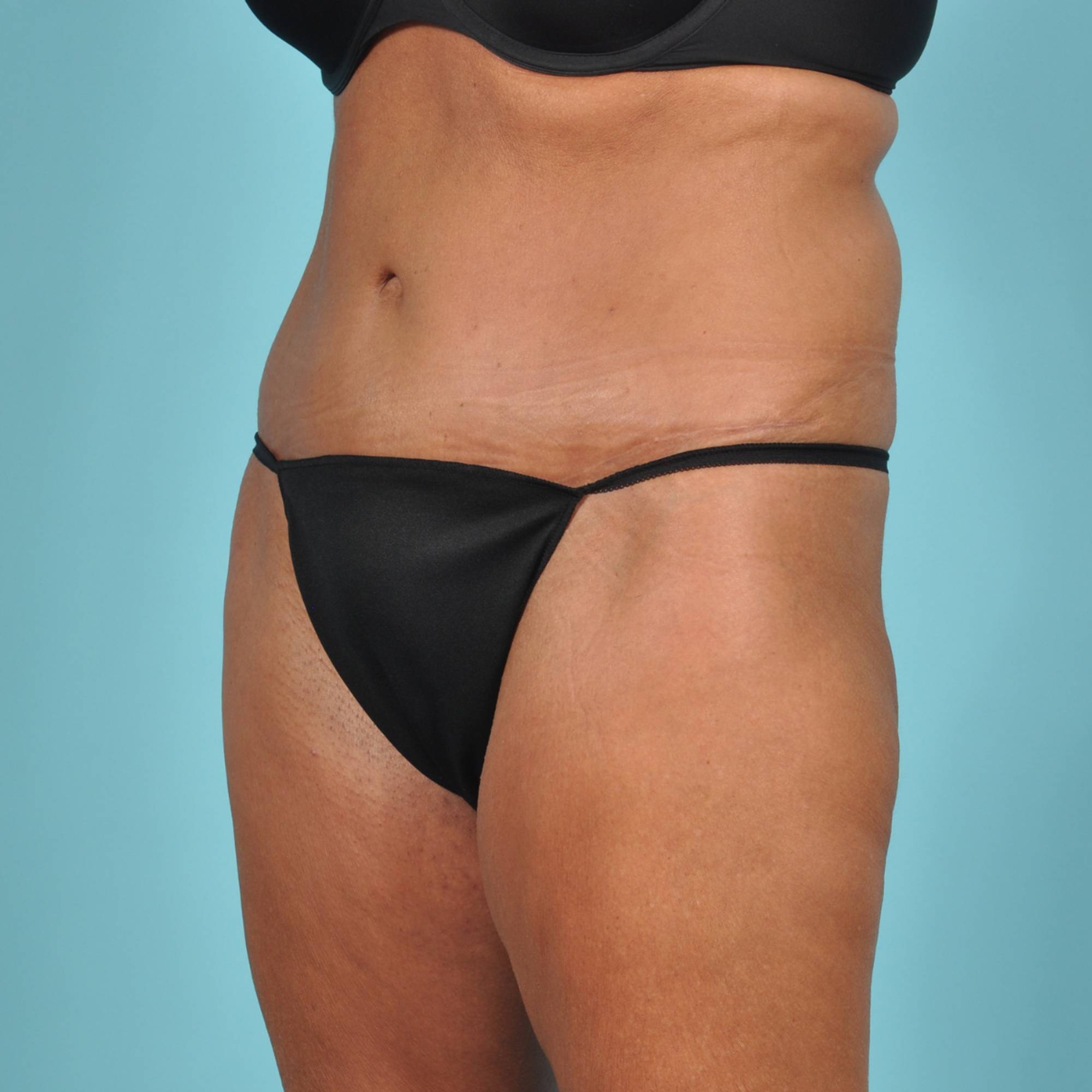Tummy Tuck Before & After Image