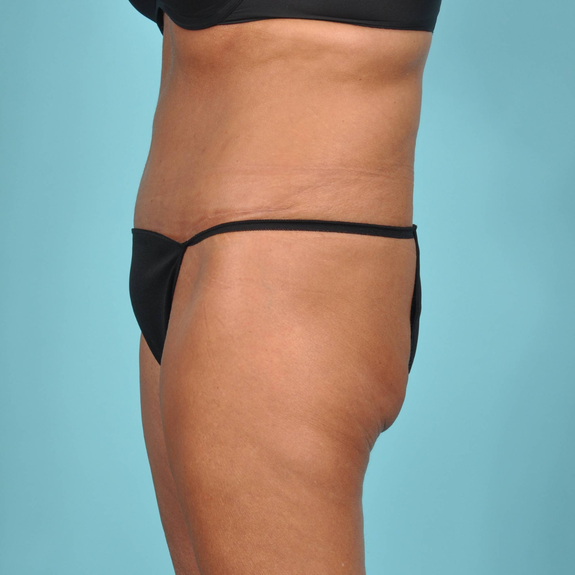 Tummy Tuck Before & After Image
