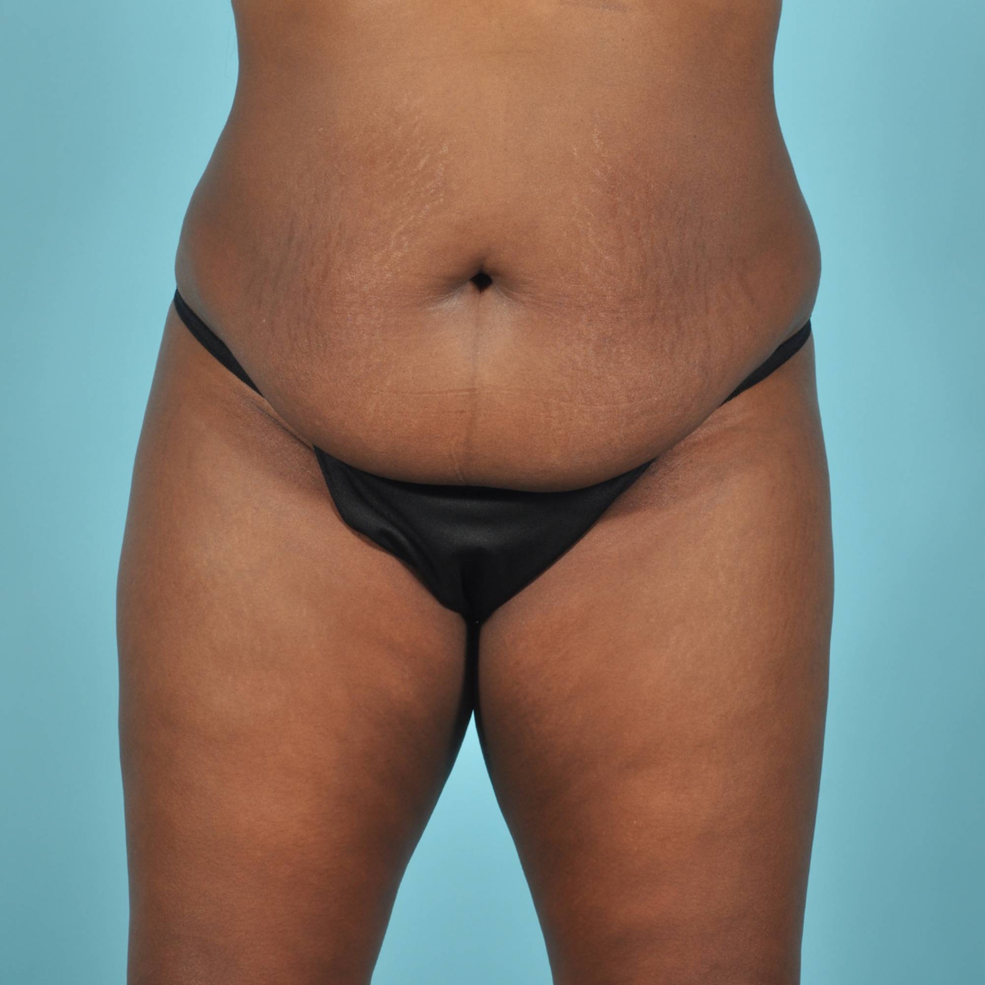 Tummy Tuck Before & After Image
