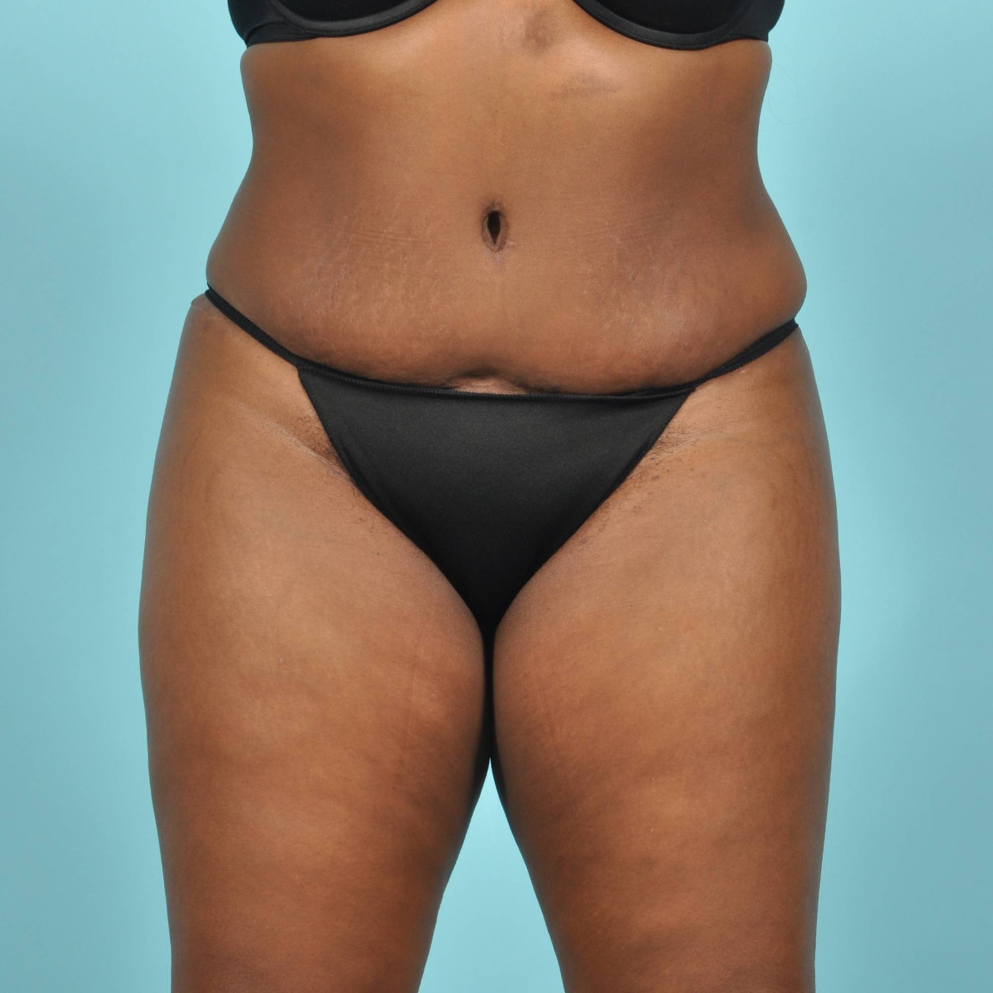 Tummy Tuck Before & After Image