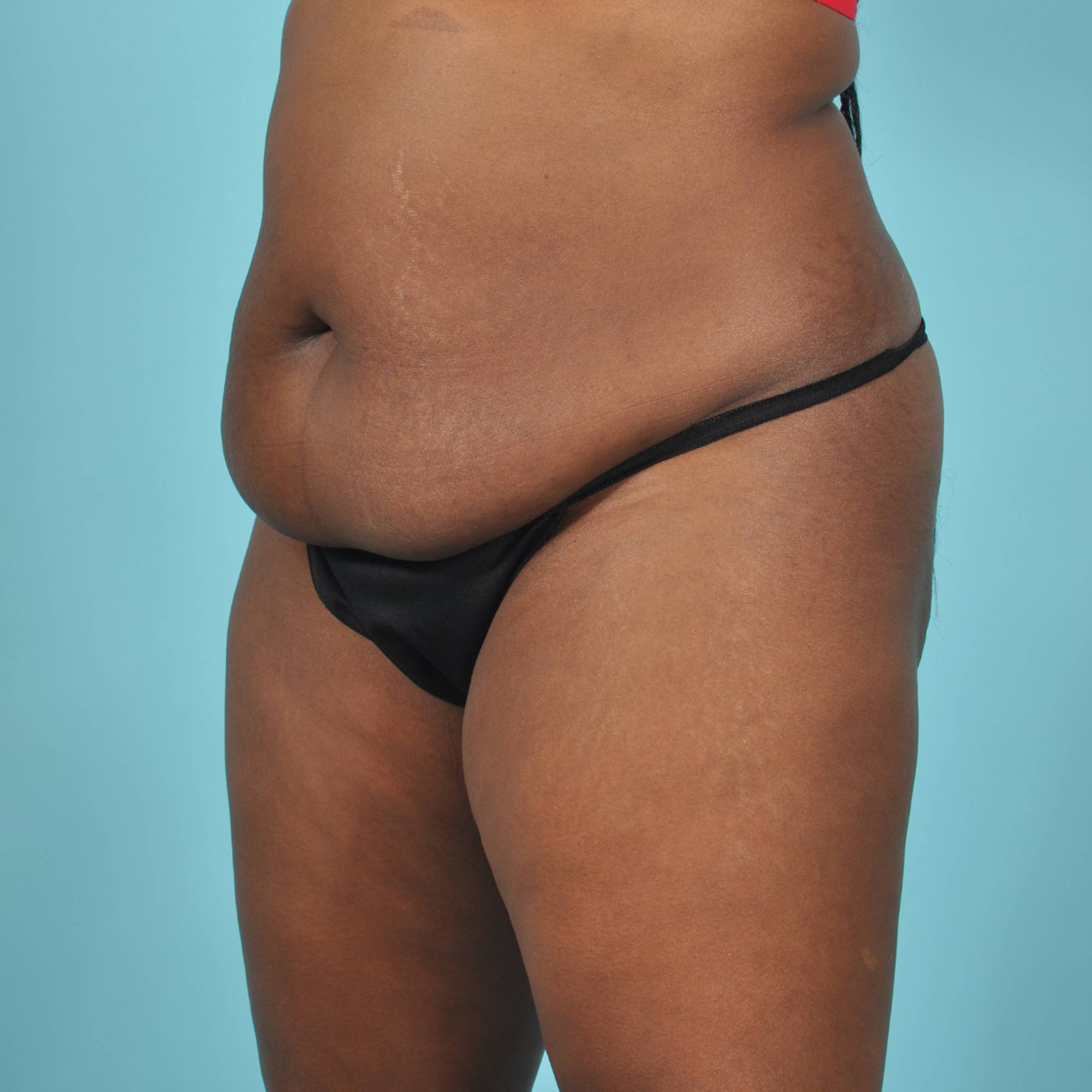 Tummy Tuck Before & After Image