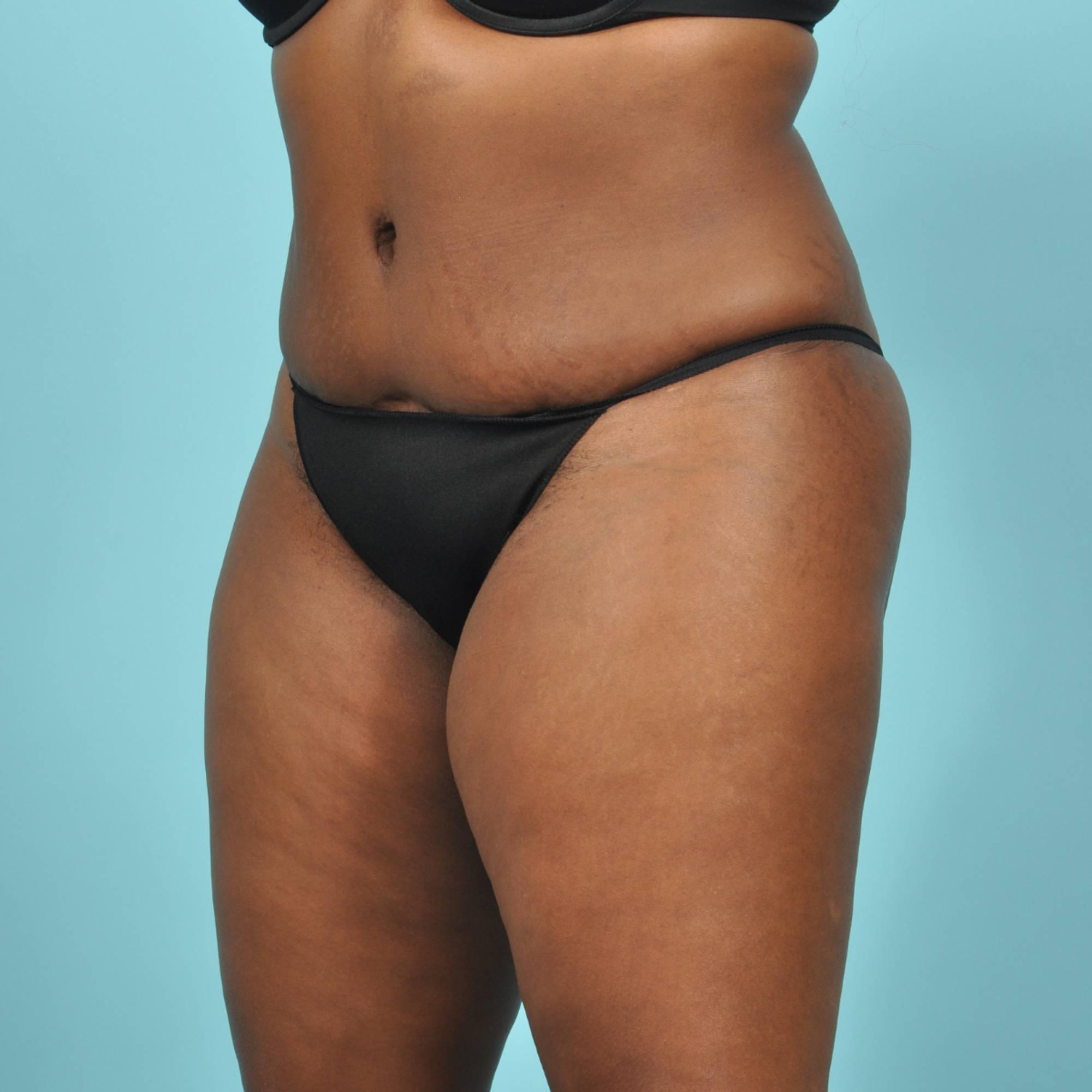 Tummy Tuck Before & After Image