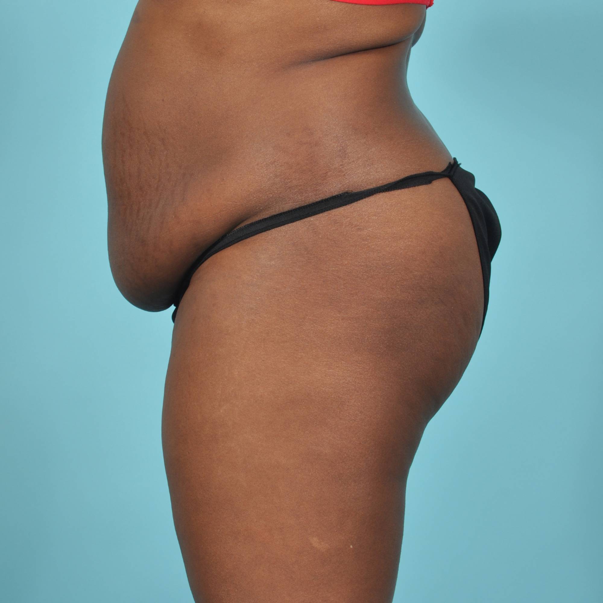 Tummy Tuck Before & After Image