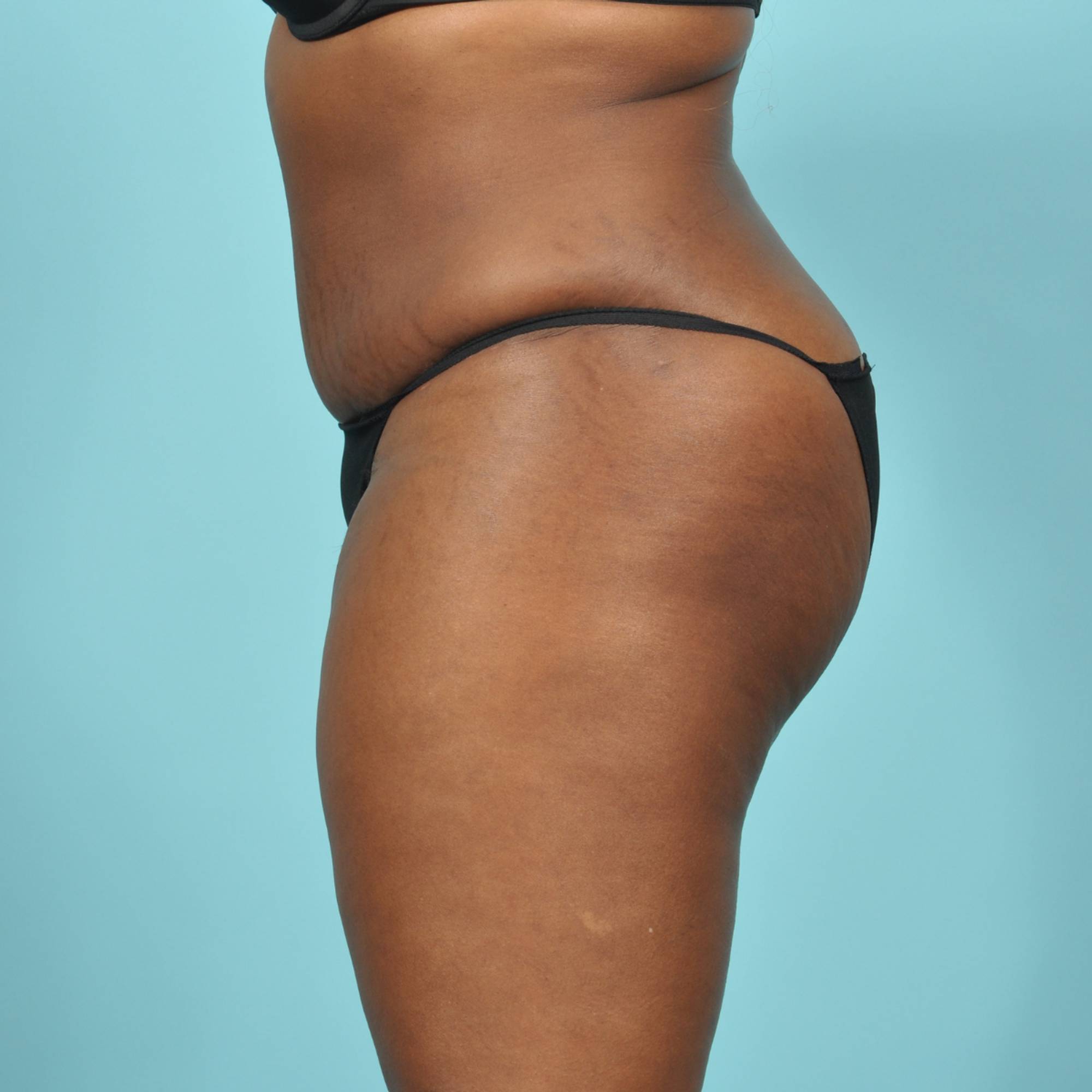 Tummy Tuck Before & After Image