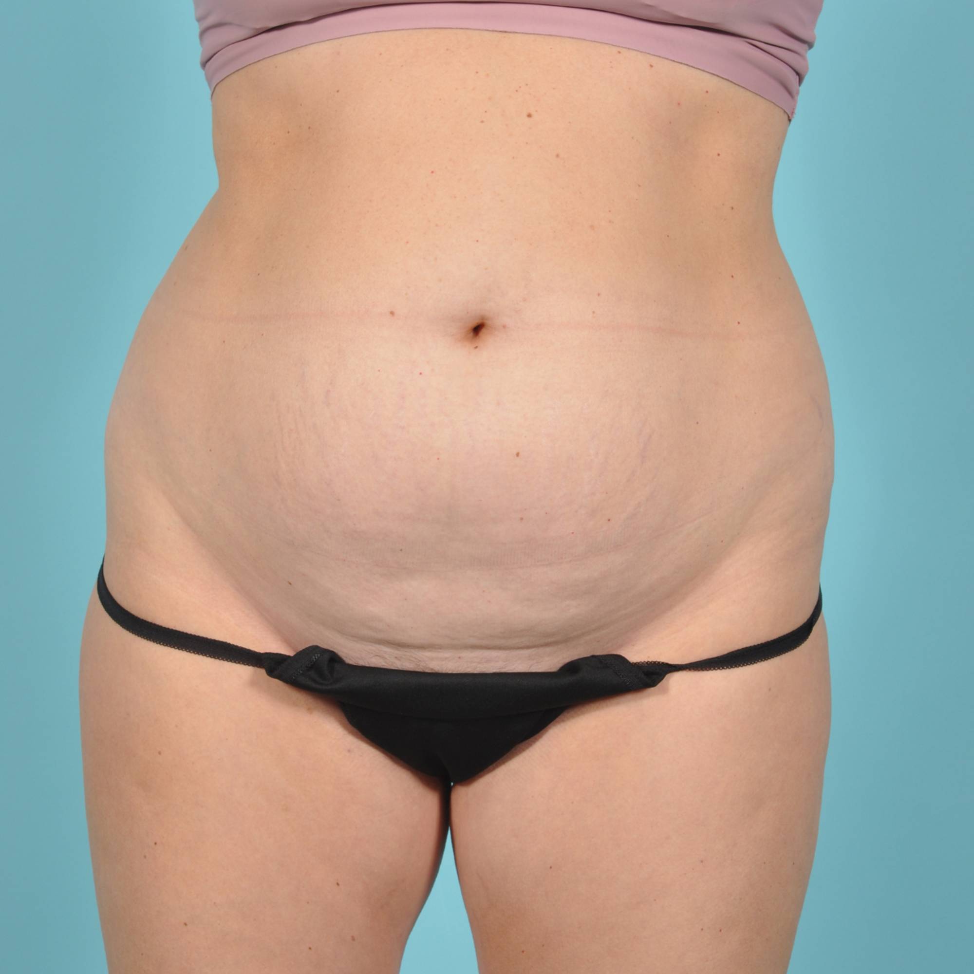 Tummy Tuck Before & After Image