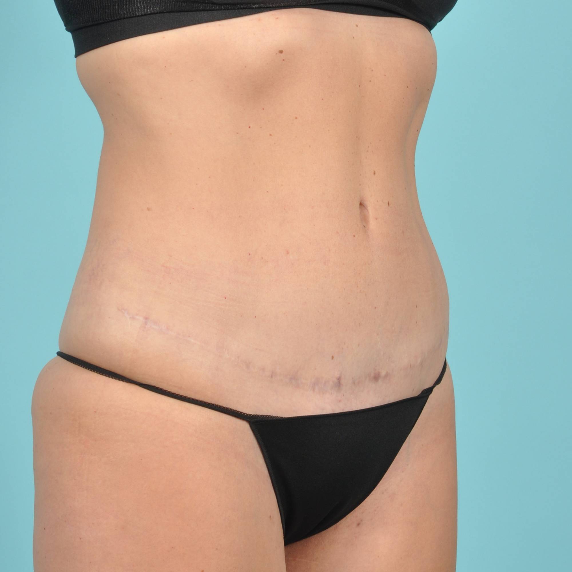 Tummy Tuck Before & After Image