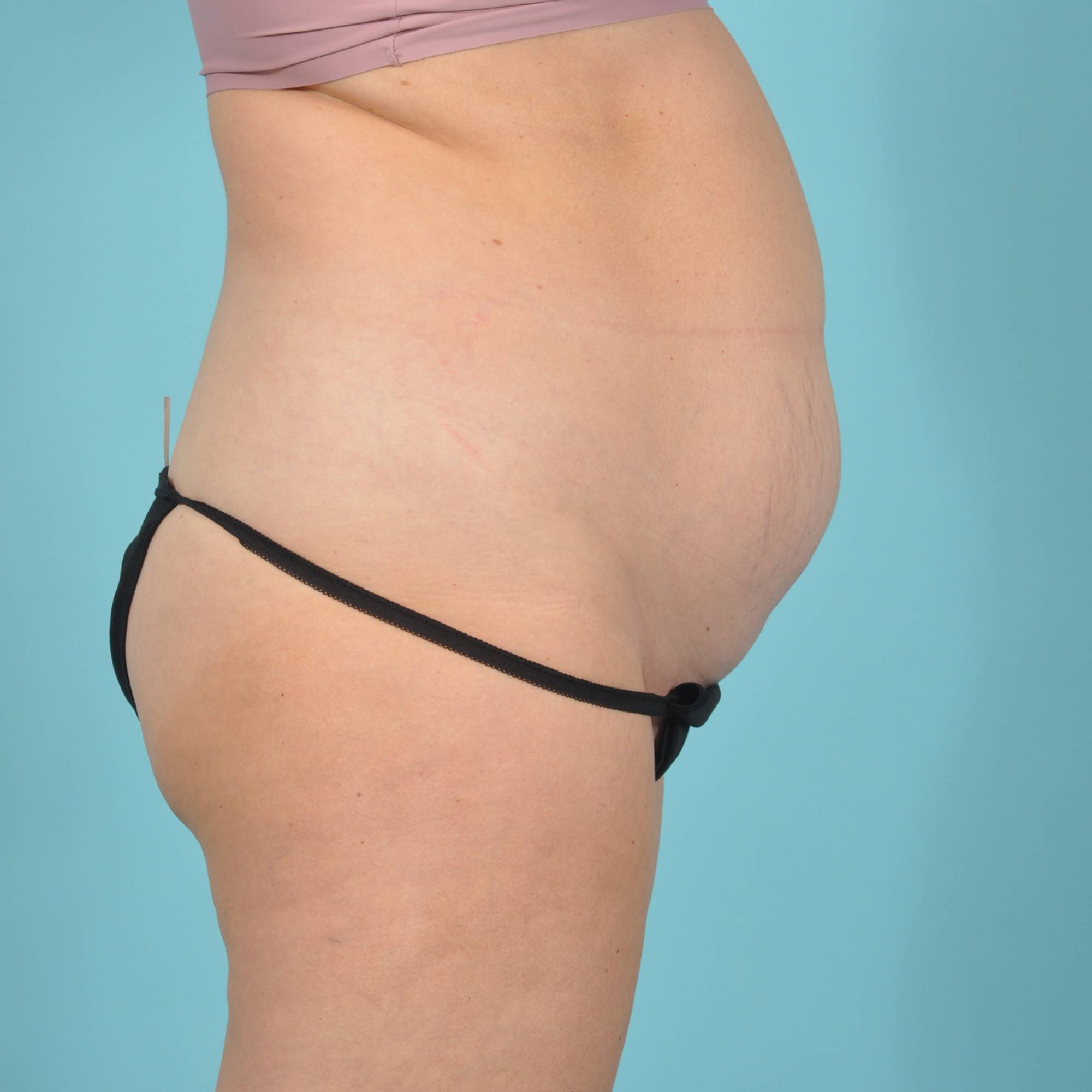 Tummy Tuck Before & After Image