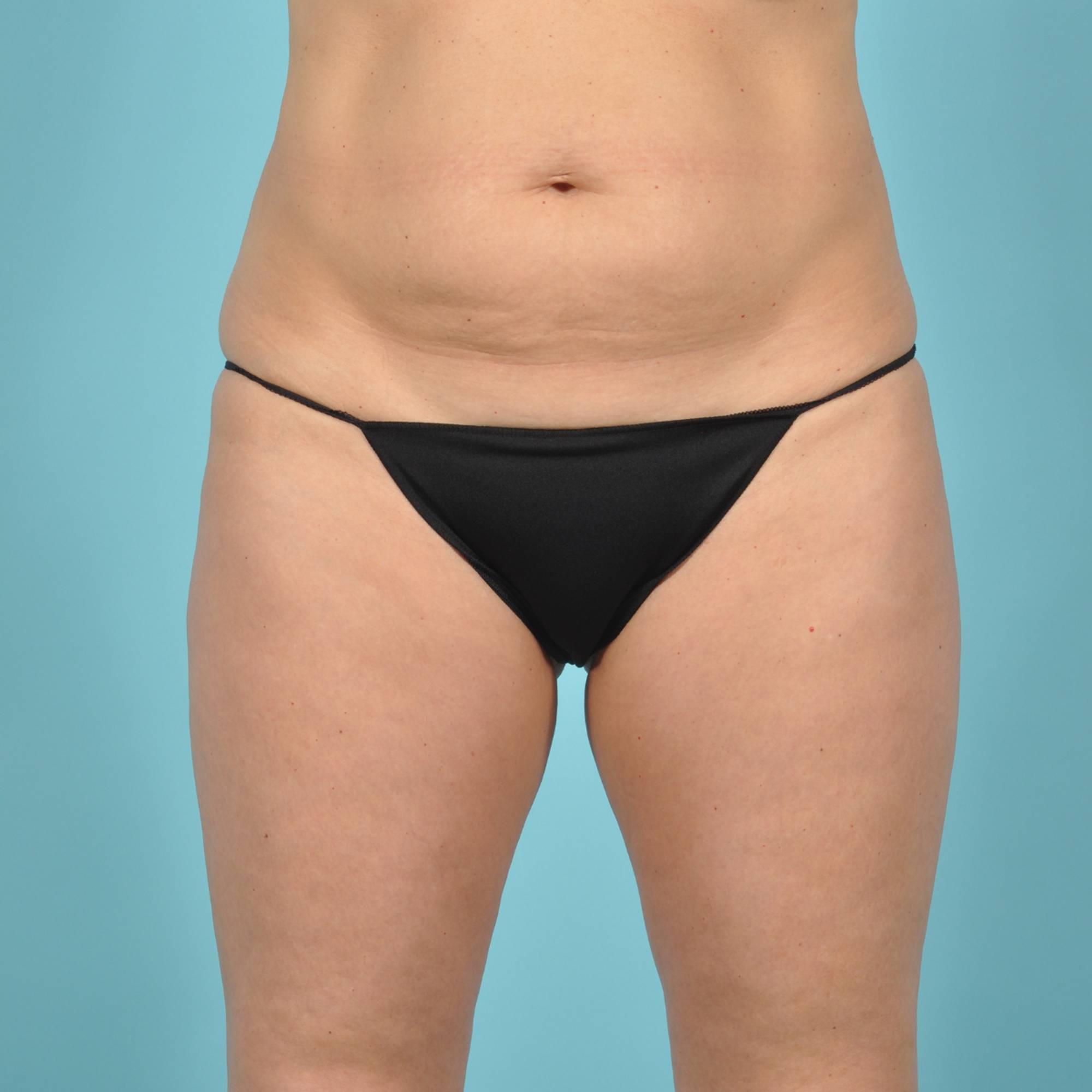 Tummy Tuck Before & After Image