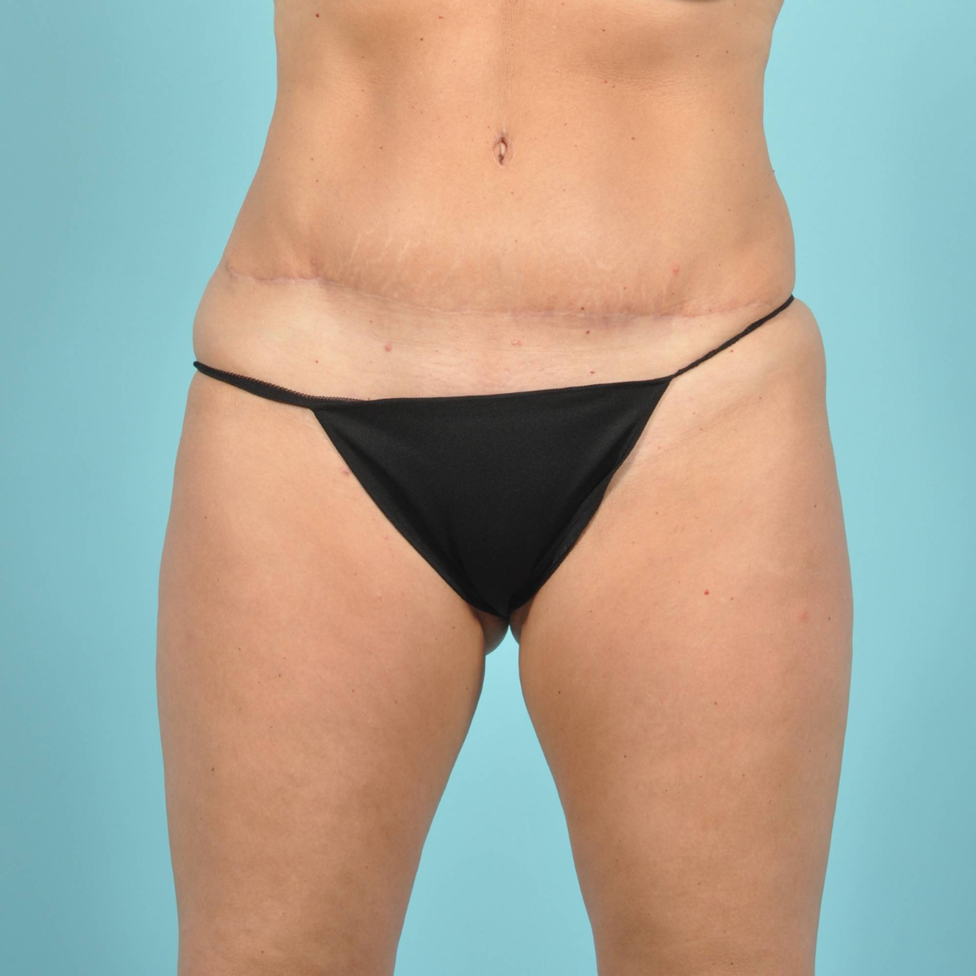 Tummy Tuck Before & After Image