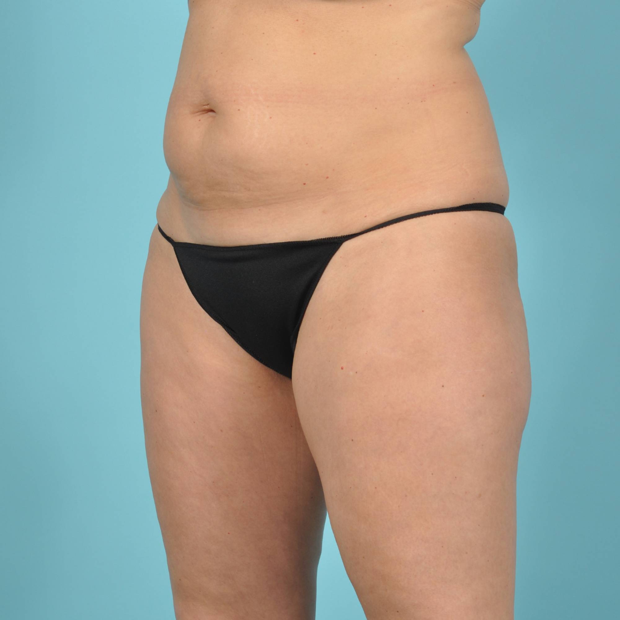 Tummy Tuck Before & After Image