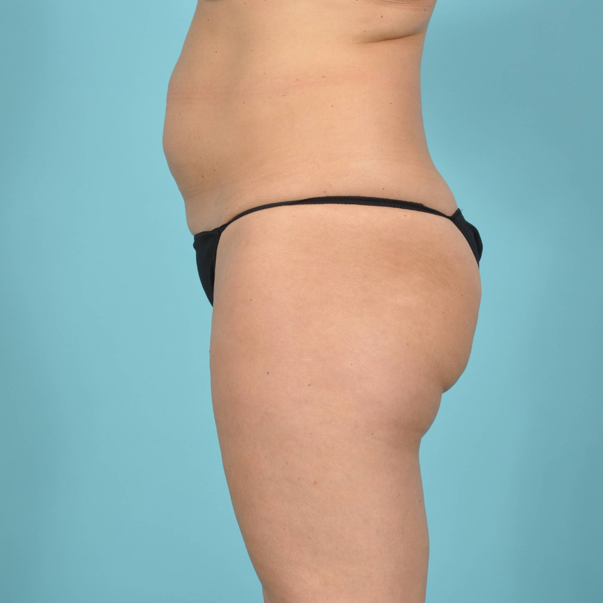 Tummy Tuck Before & After Image