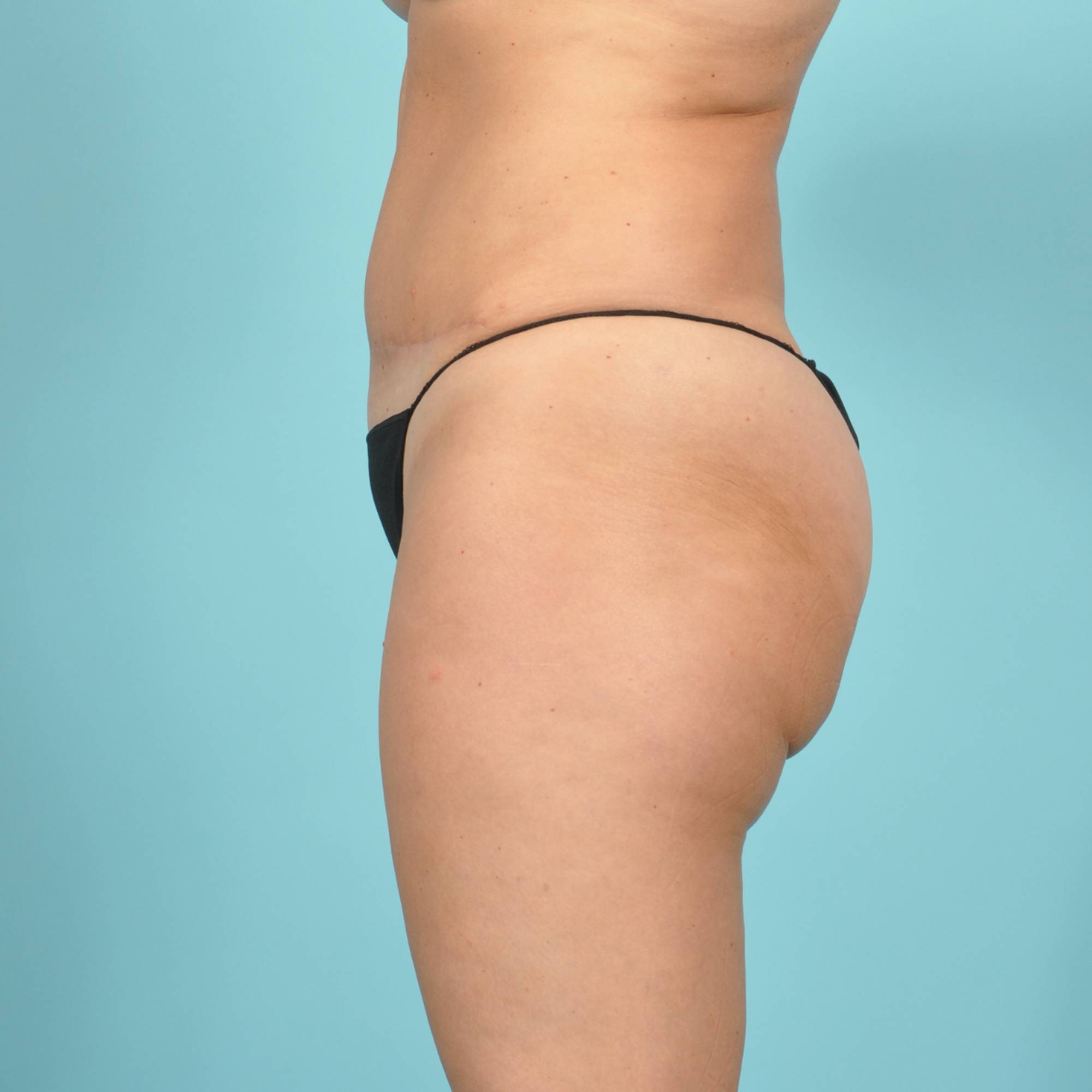 Tummy Tuck Before & After Image