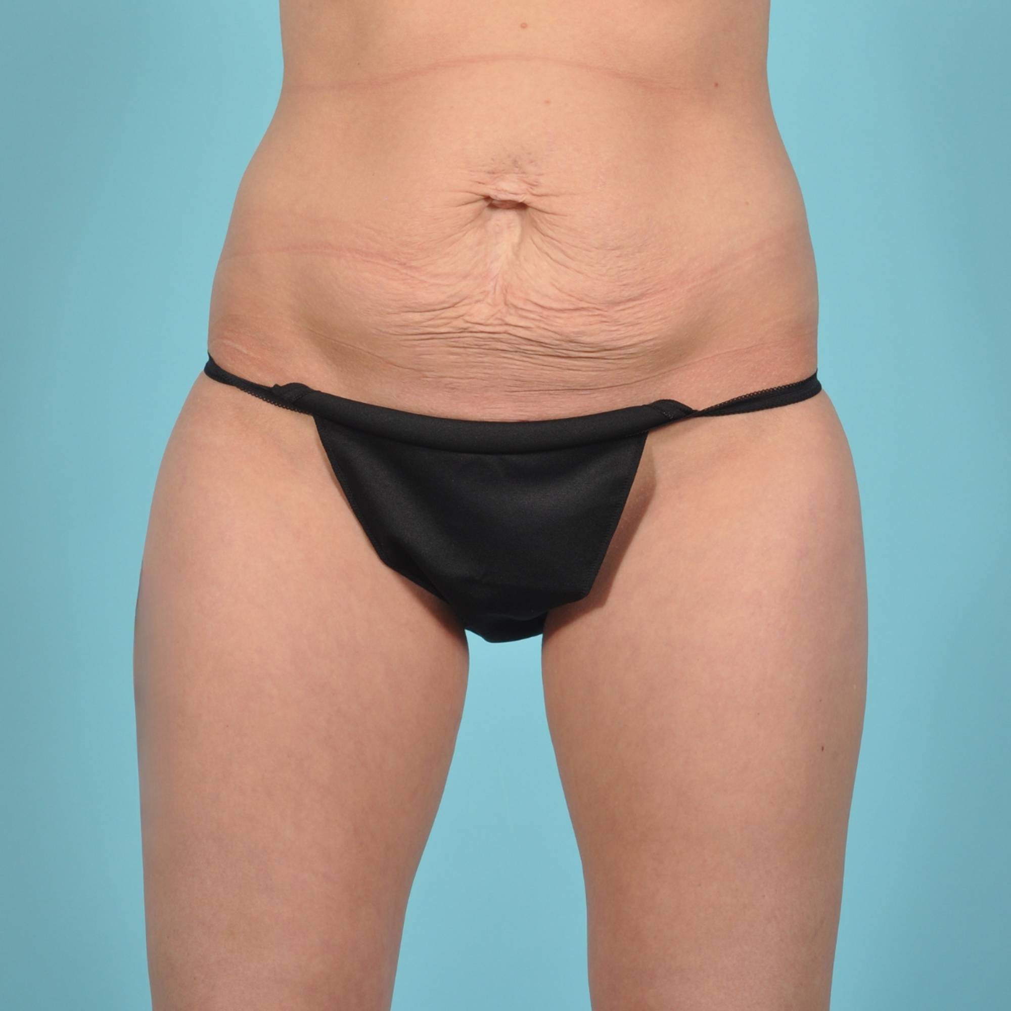 Tummy Tuck Before & After Image