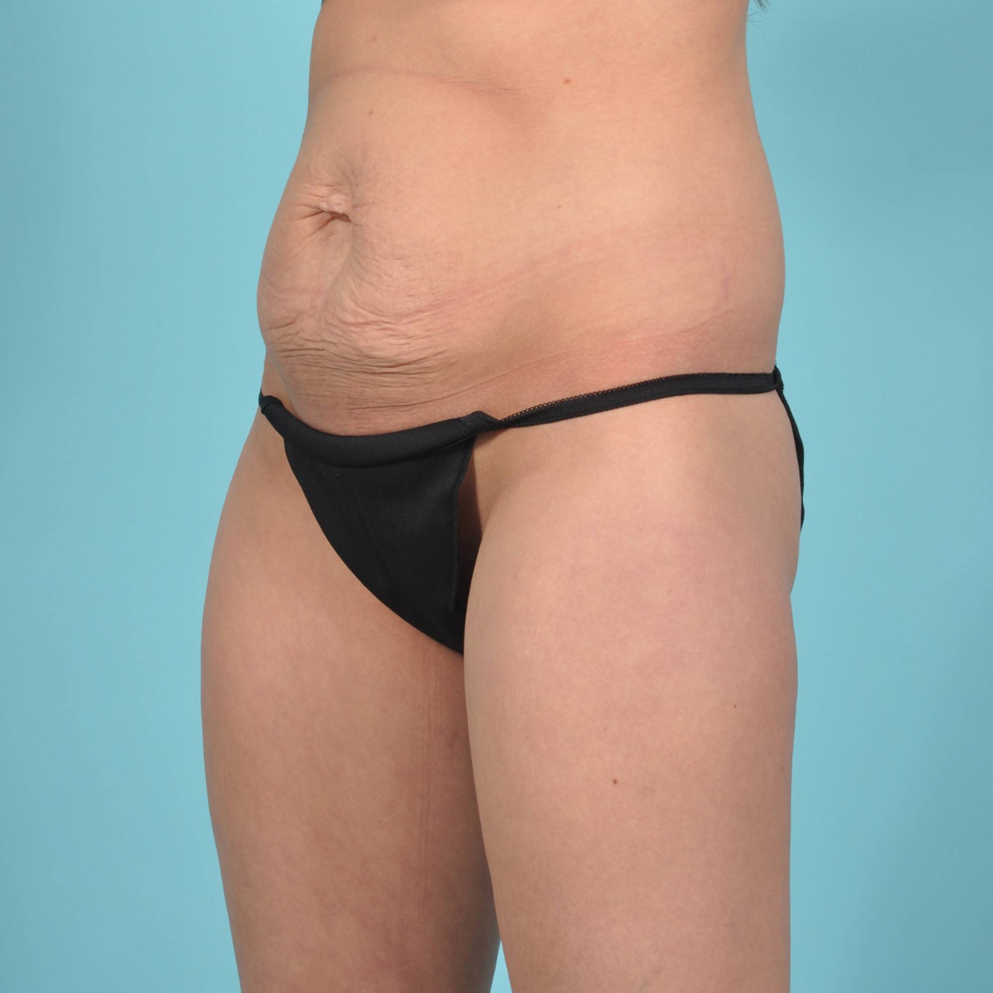 Tummy Tuck Before & After Image