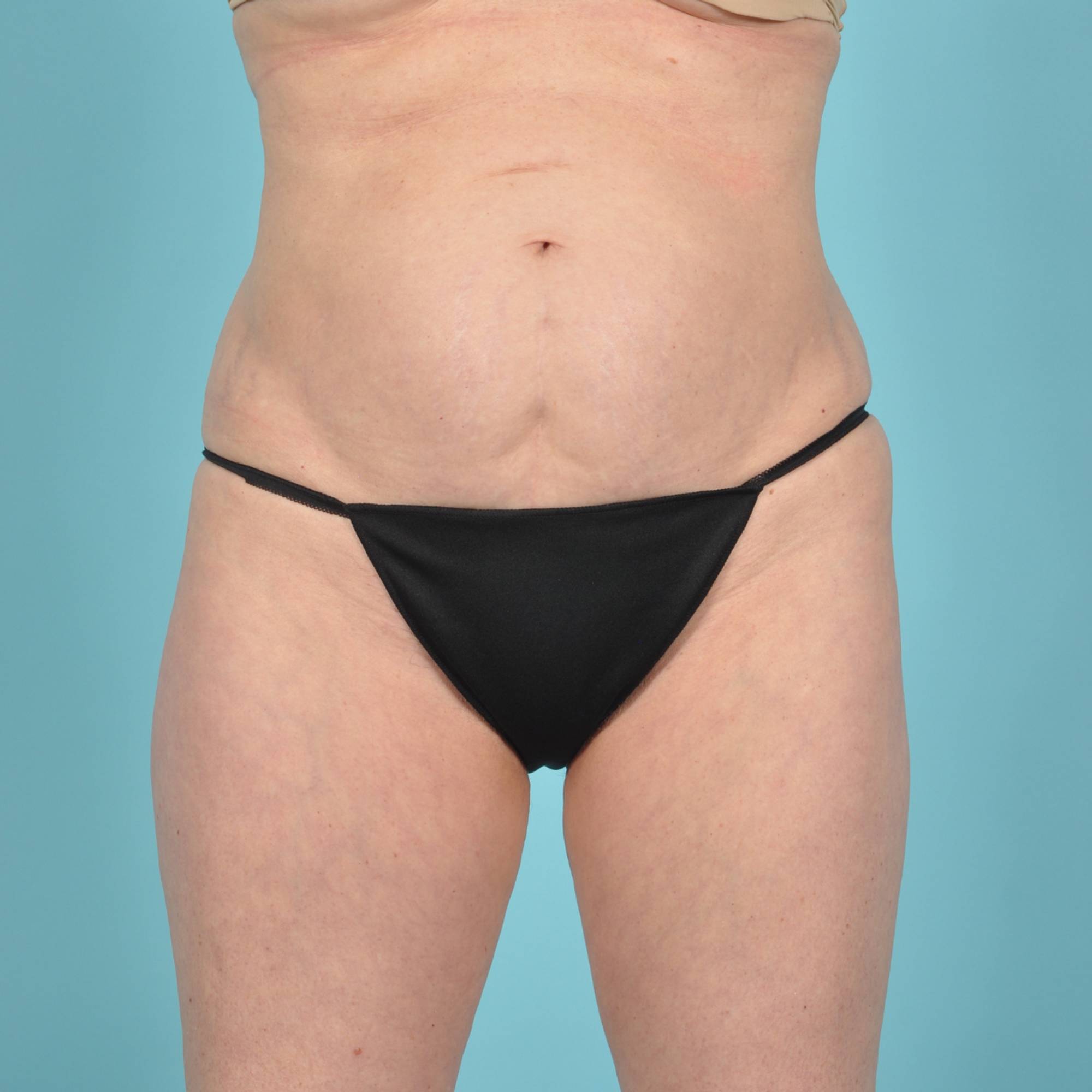 Tummy Tuck Before & After Image