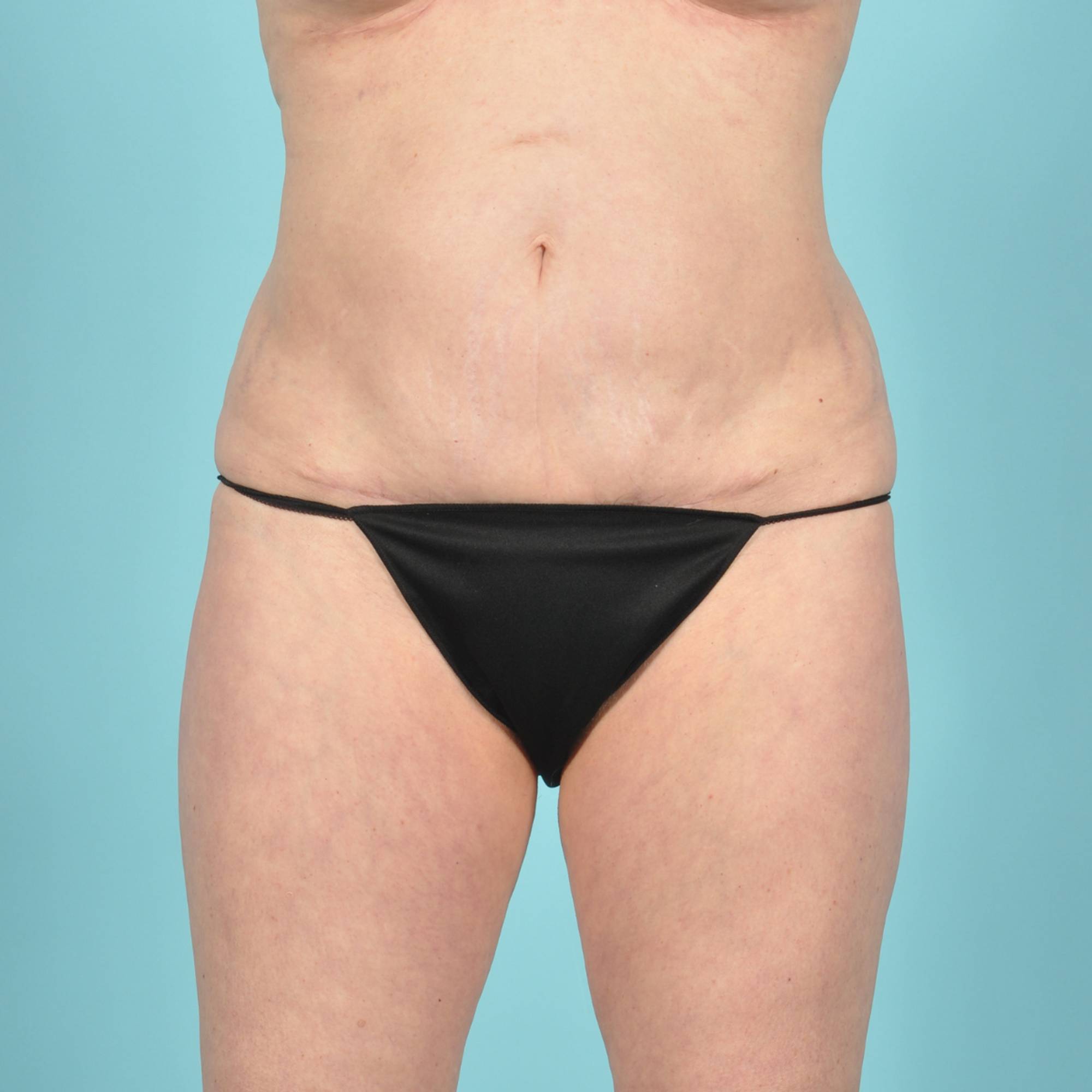 Tummy Tuck Before & After Image