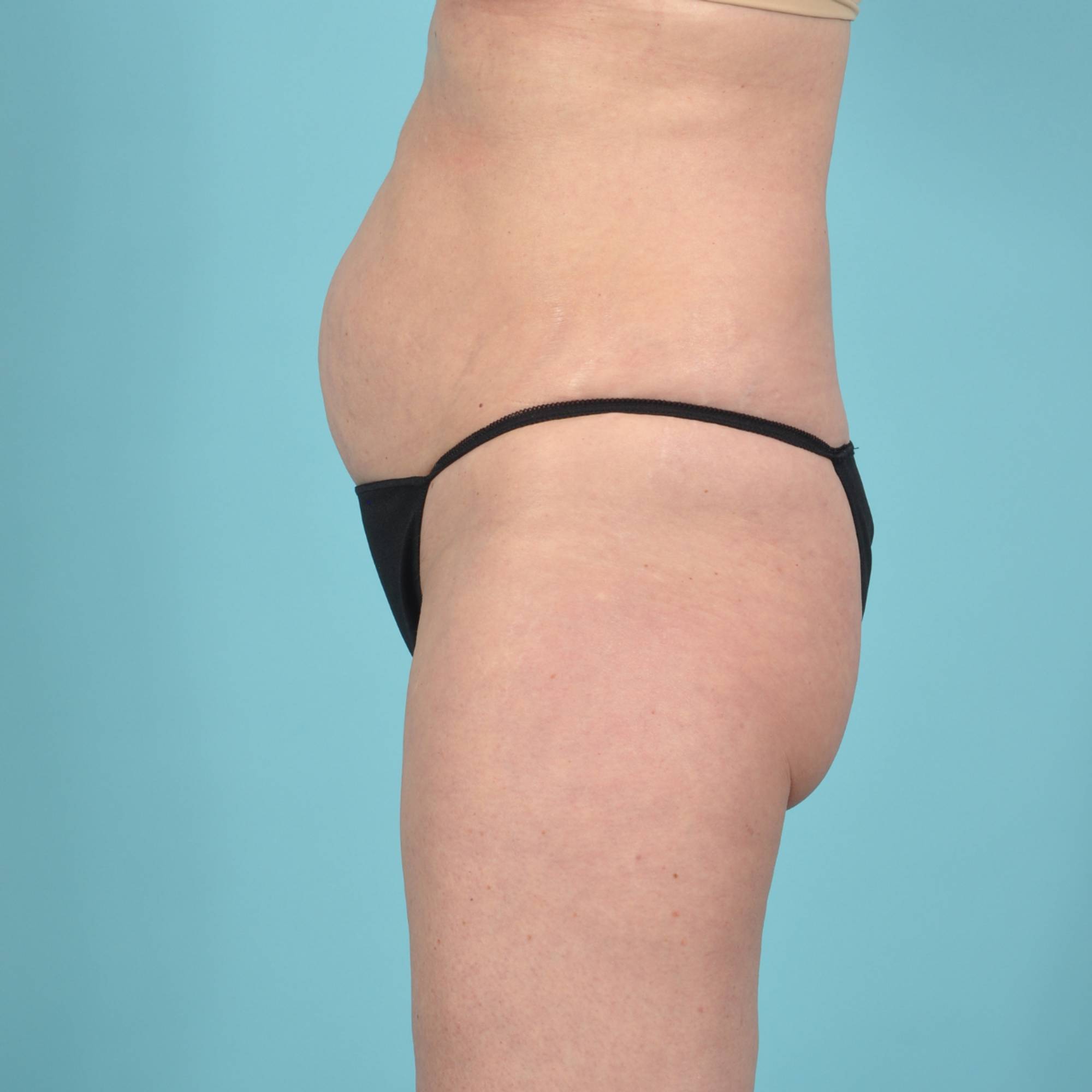 Tummy Tuck Before & After Image