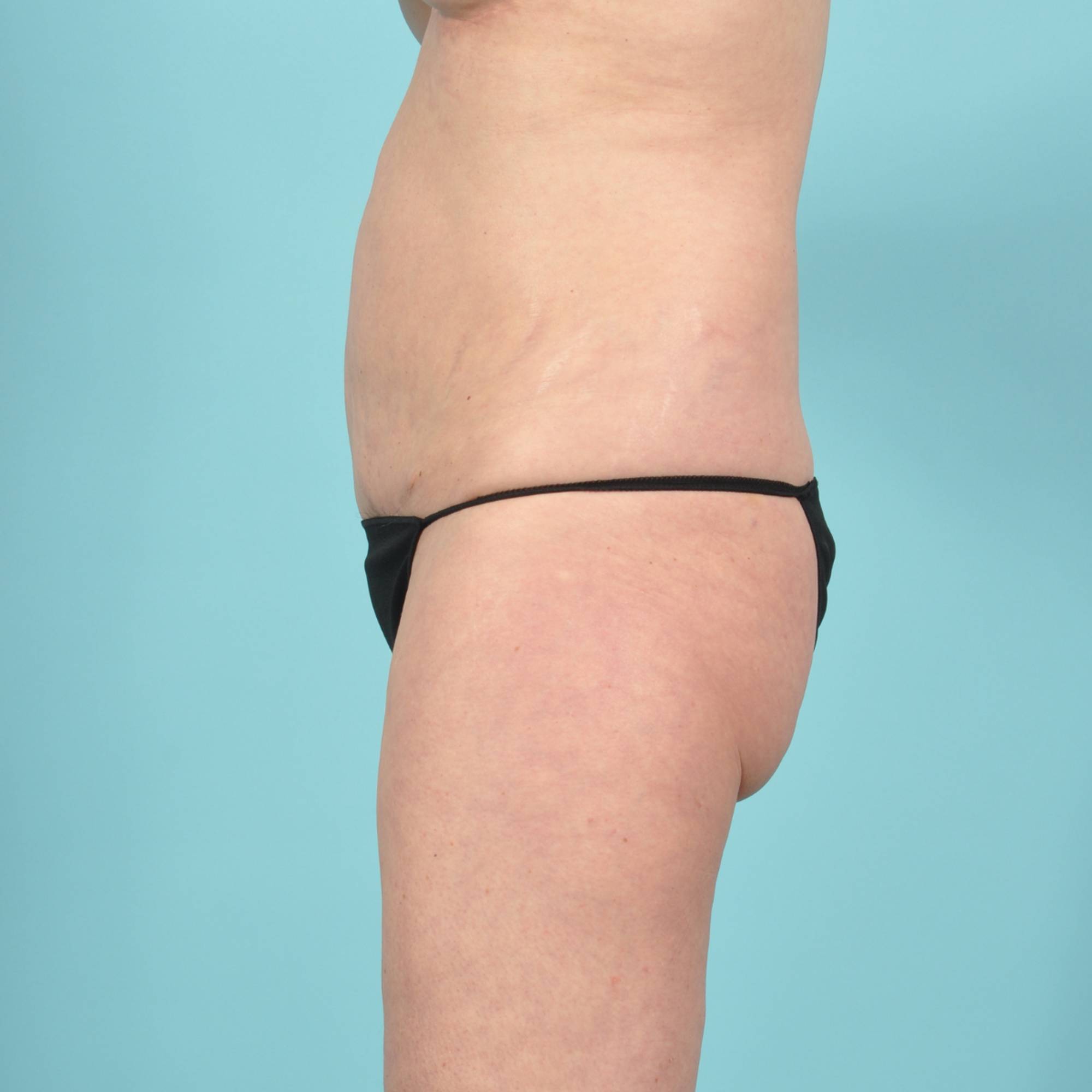 Tummy Tuck Before & After Image