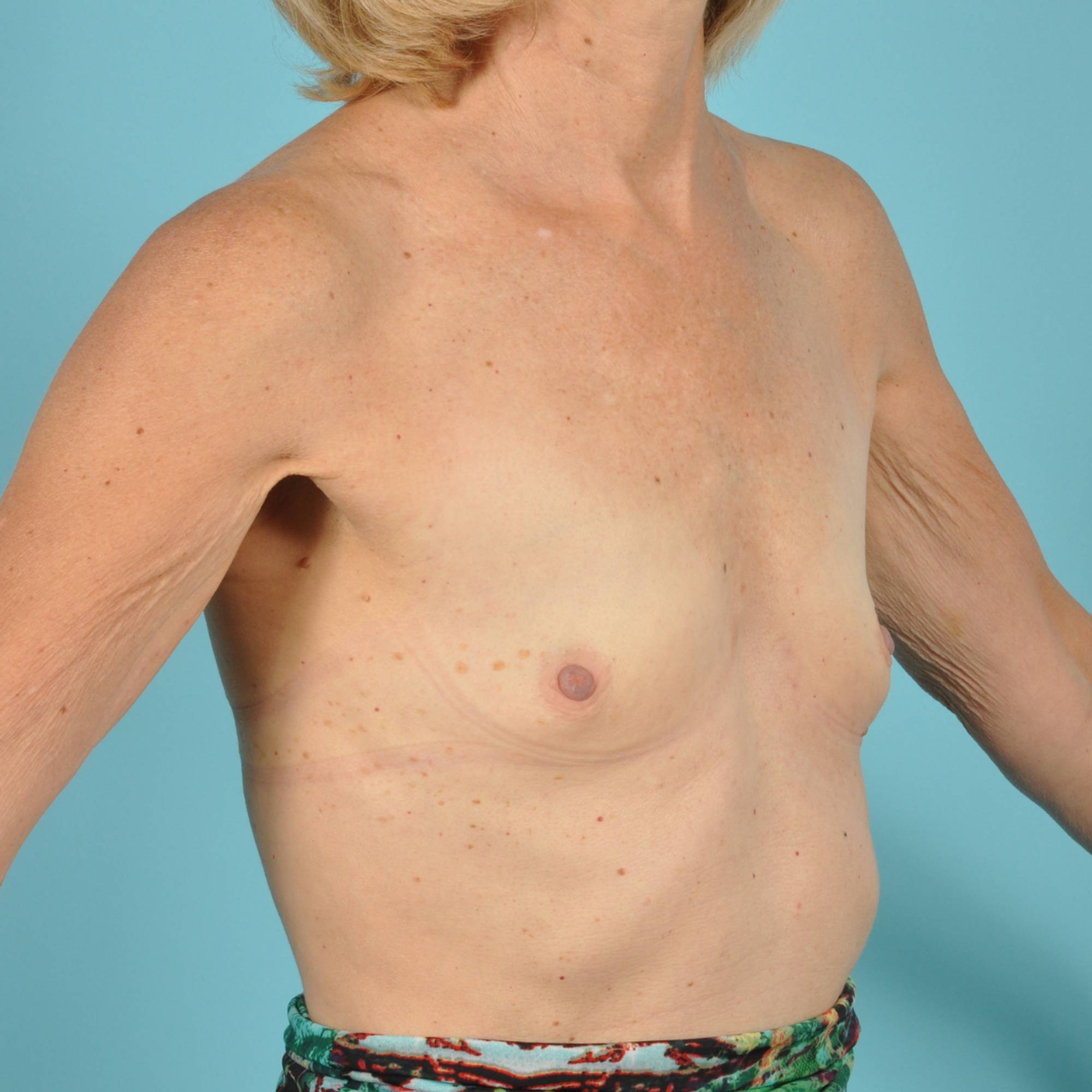 Breast Augmentation Before & After Image