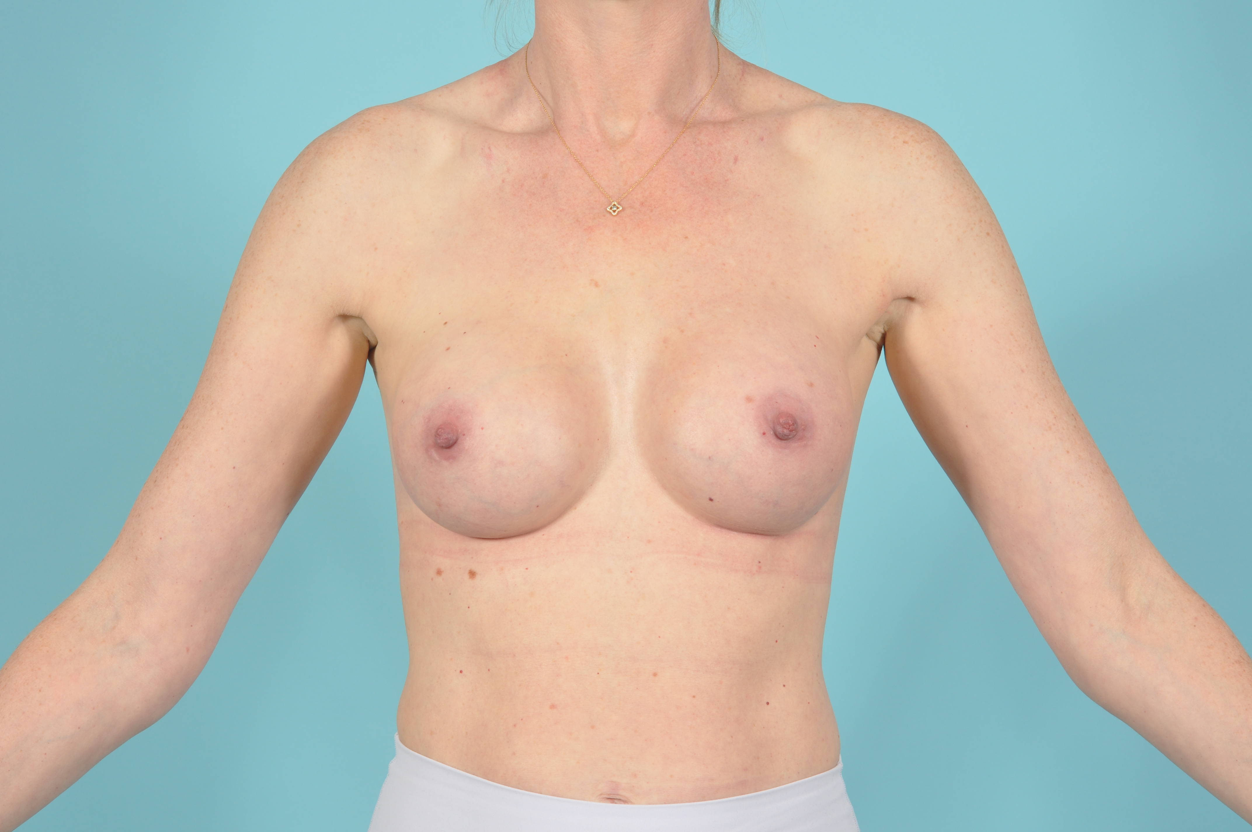 Breast Augmentation Before & After Image
