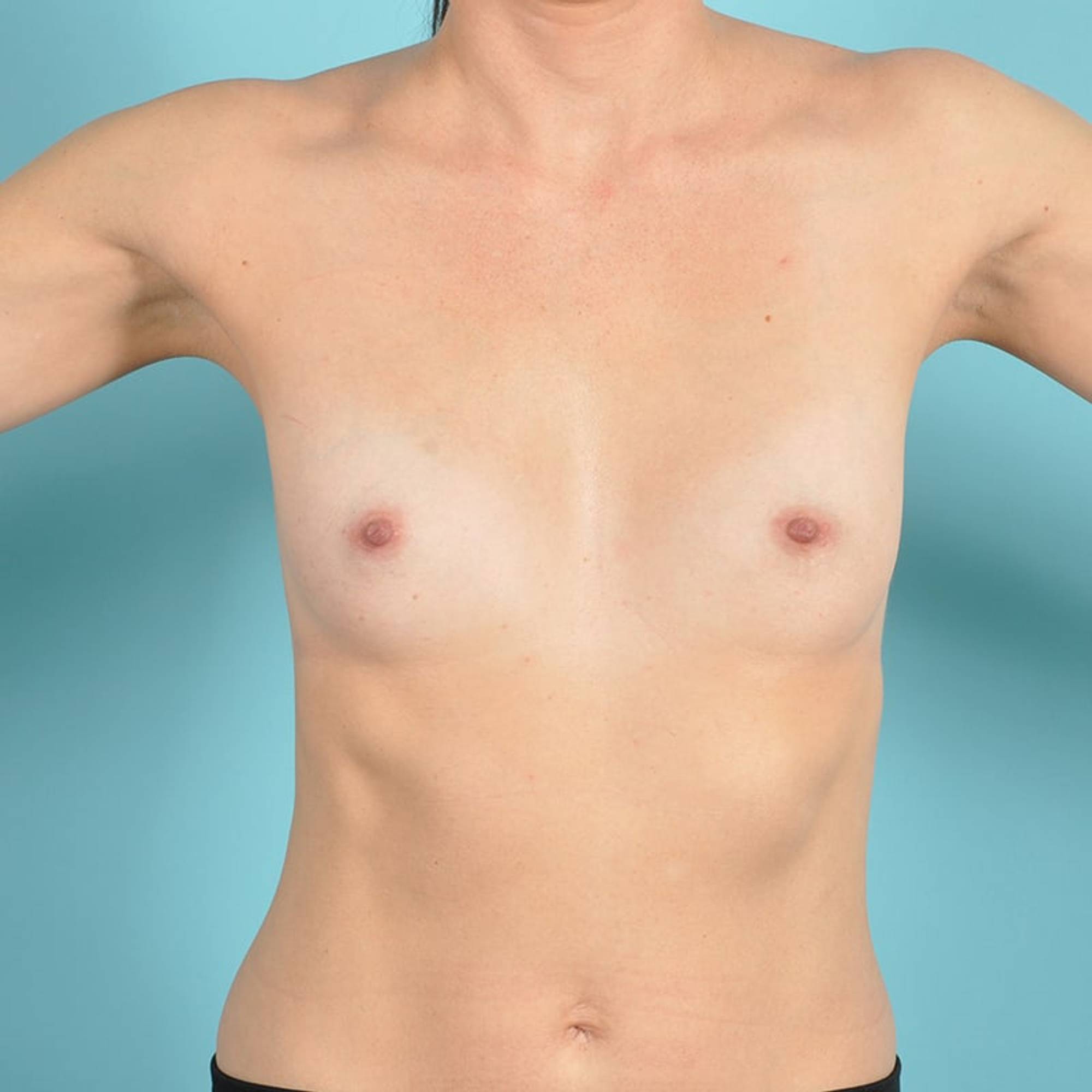 Breast Augmentation Before & After Image