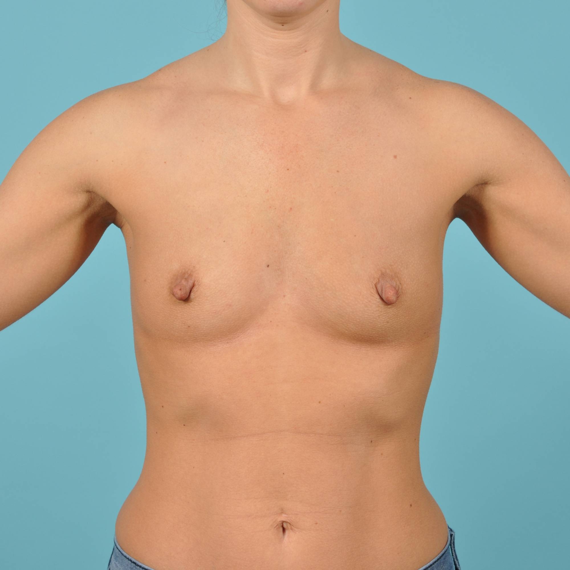 Breast Augmentation Before & After Image