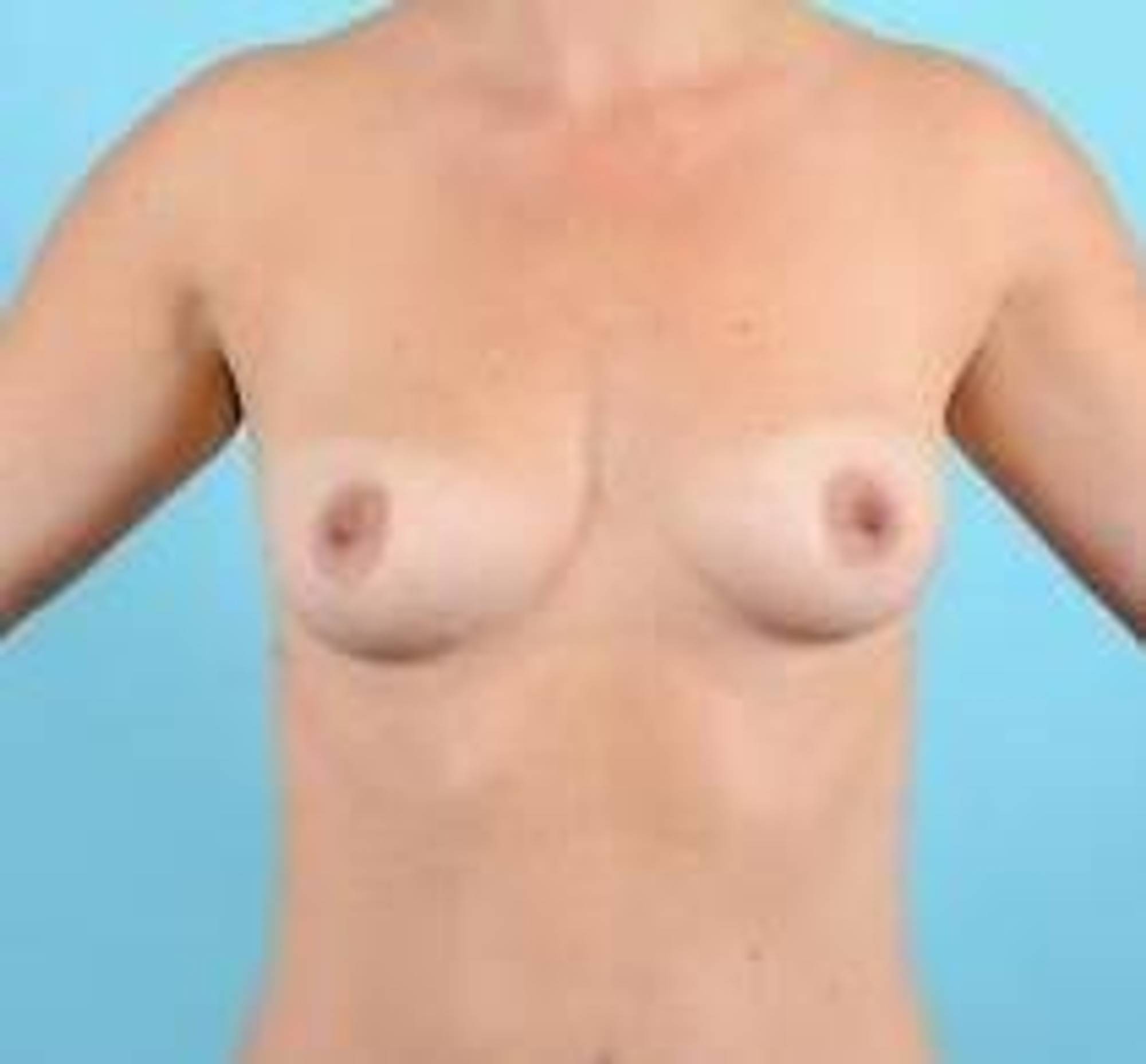 Breast Augmentation Before & After Image