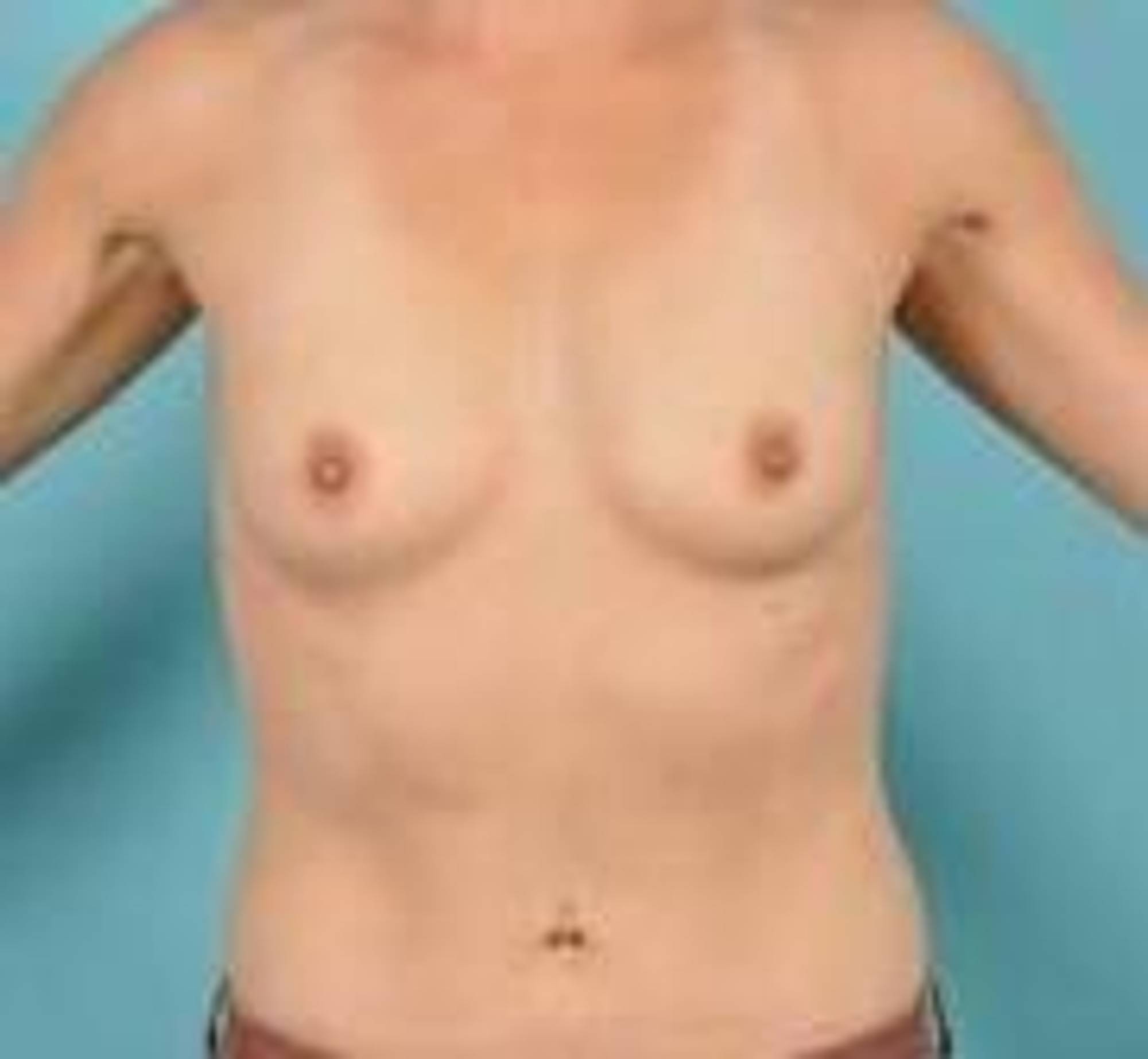 Breast Augmentation Before & After Image