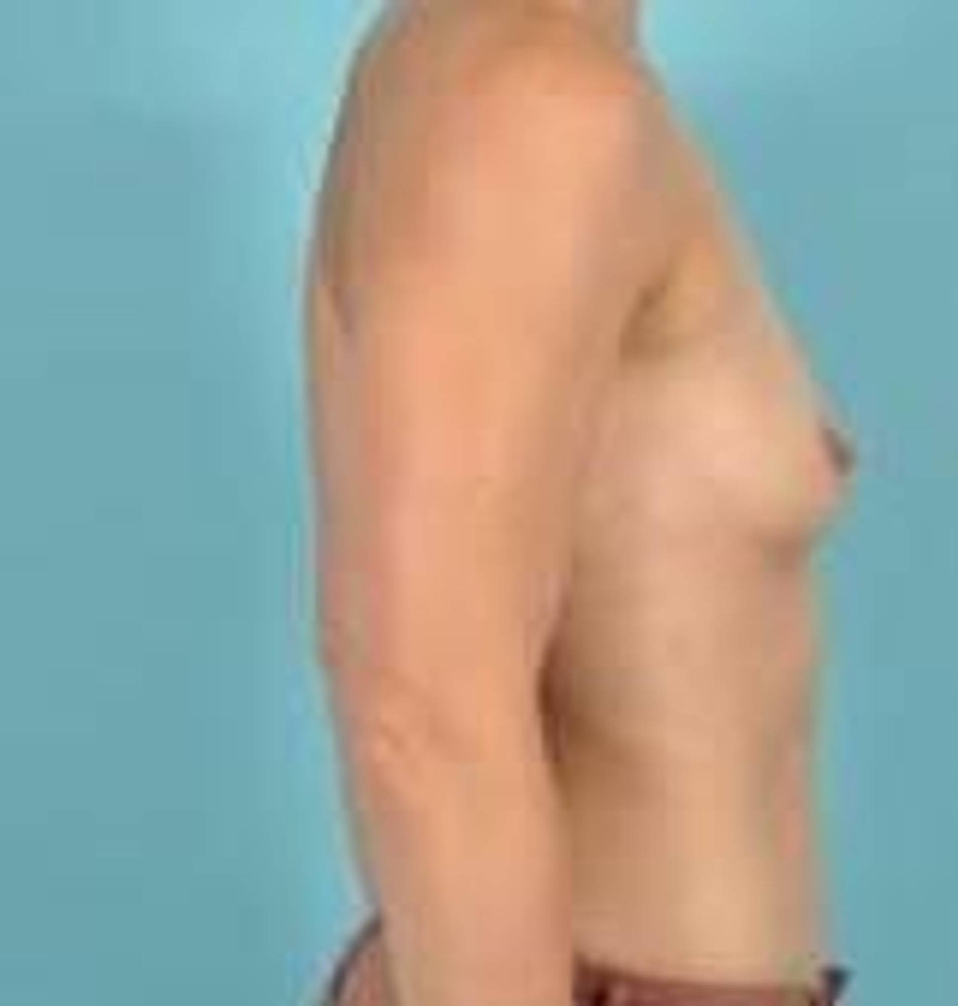 Breast Augmentation Before & After Image