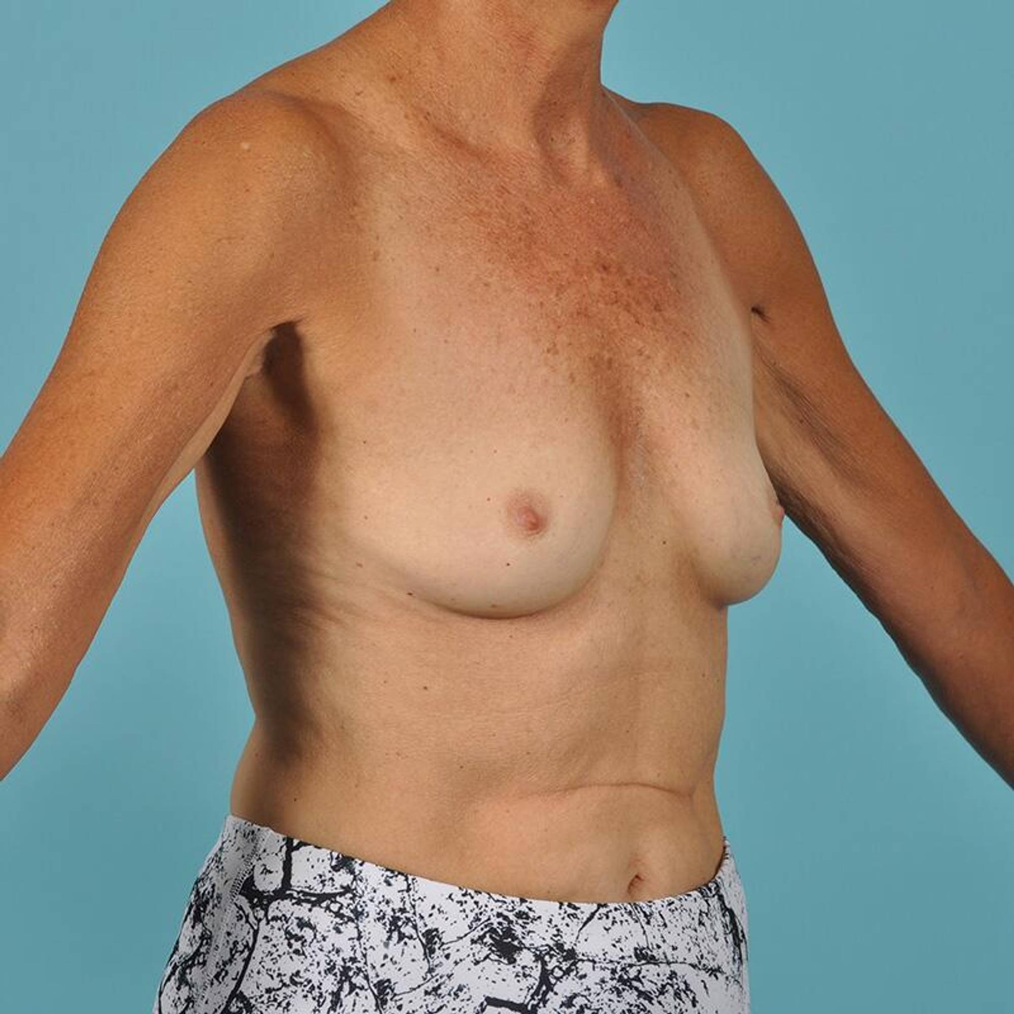  Before & After Image