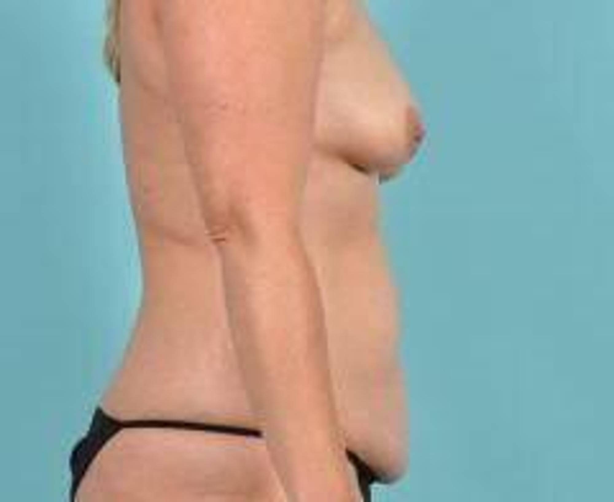 Breast Augmentation Before & After Image