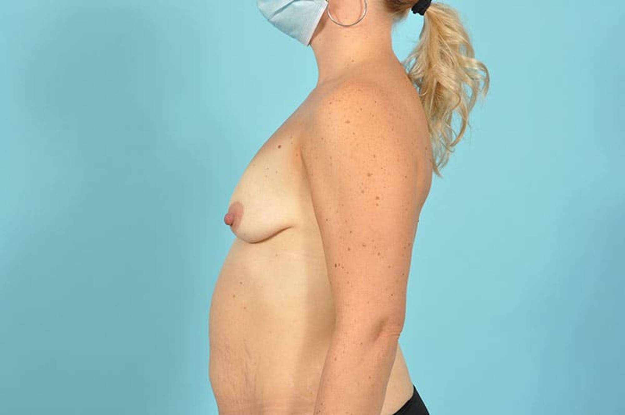 Breast Augmentation Before & After Image