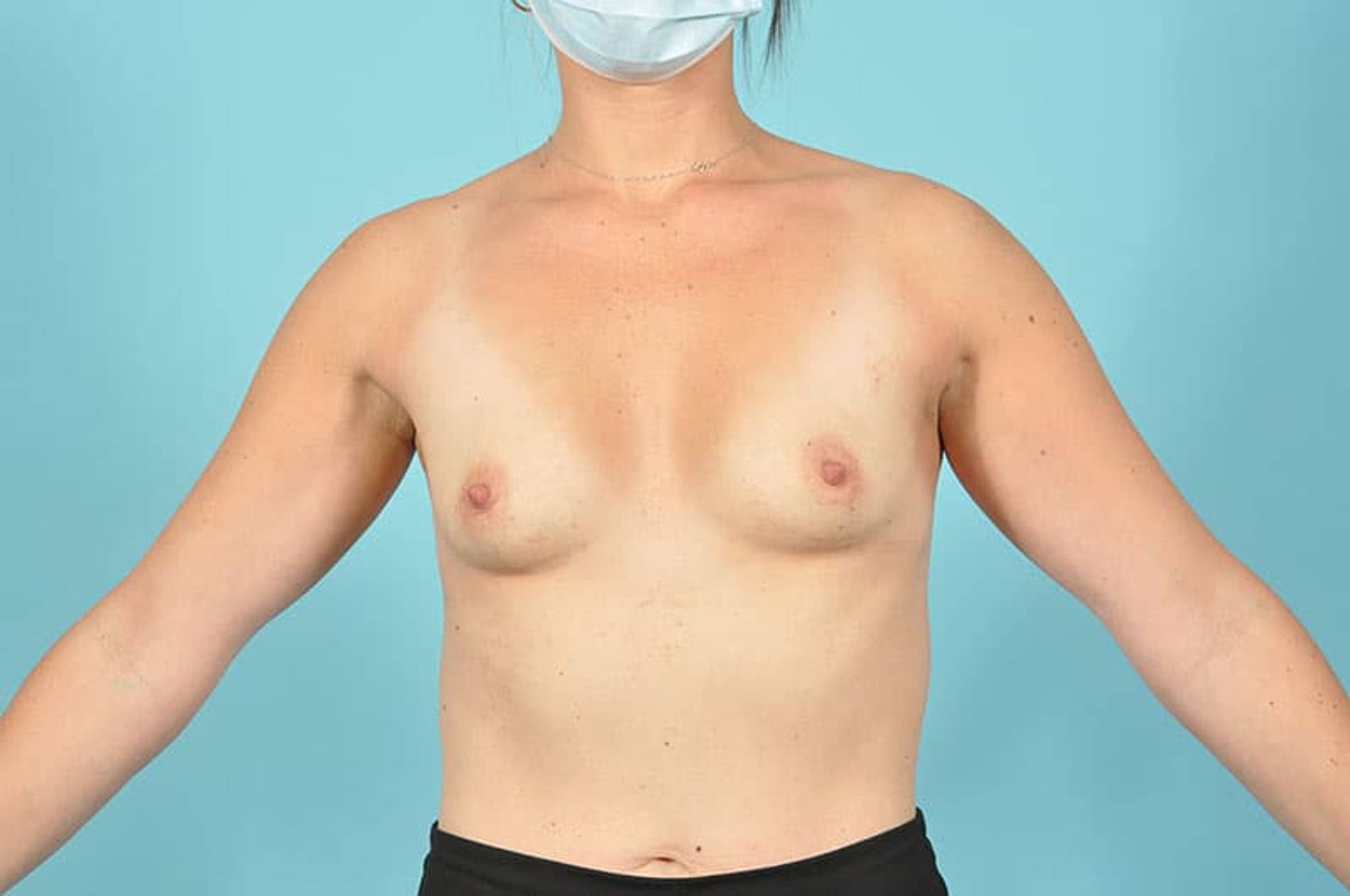 Breast Augmentation Before & After Image