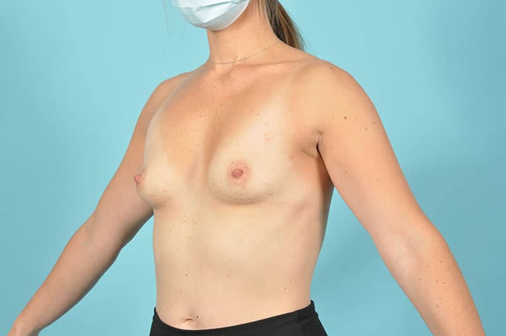 Breast Augmentation Before & After Image