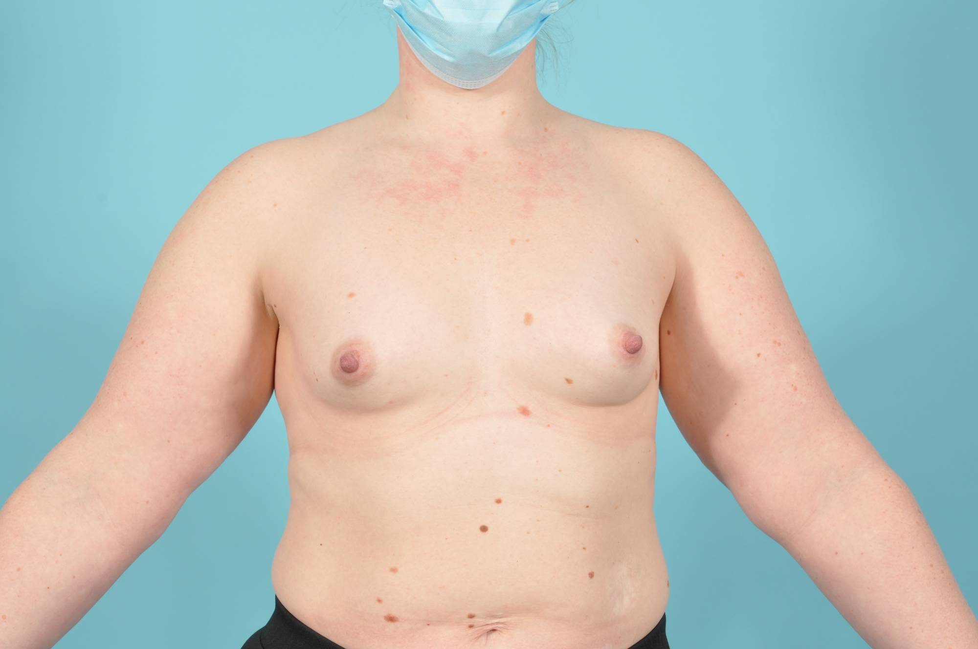 Breast Augmentation Before & After Image