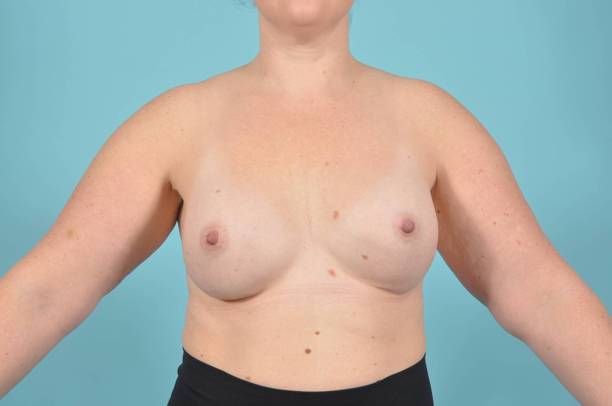 Breast Augmentation Before & After Image