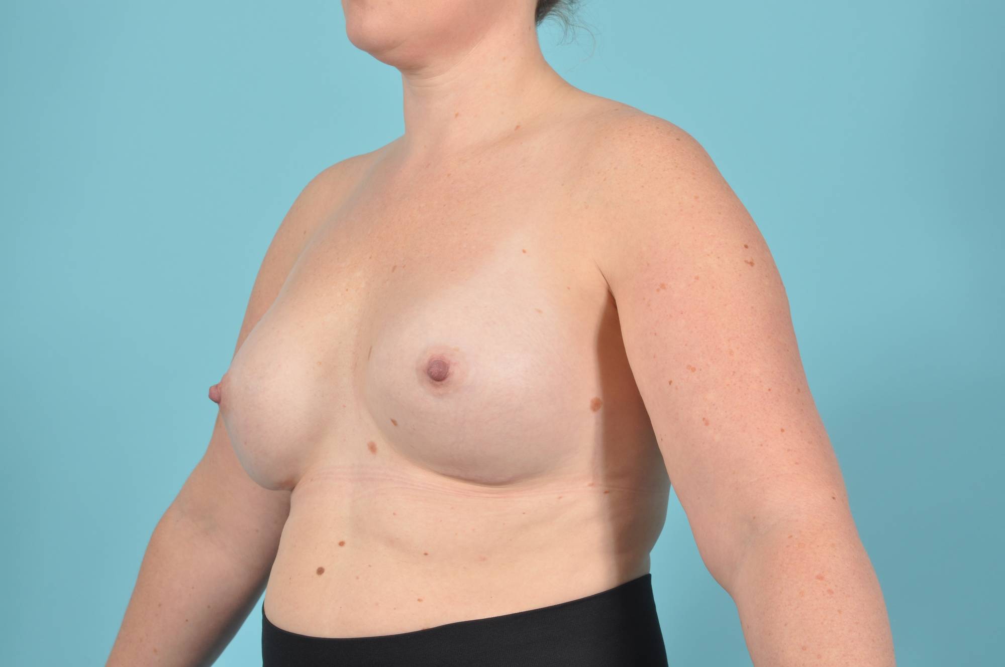 Breast Augmentation Before & After Image