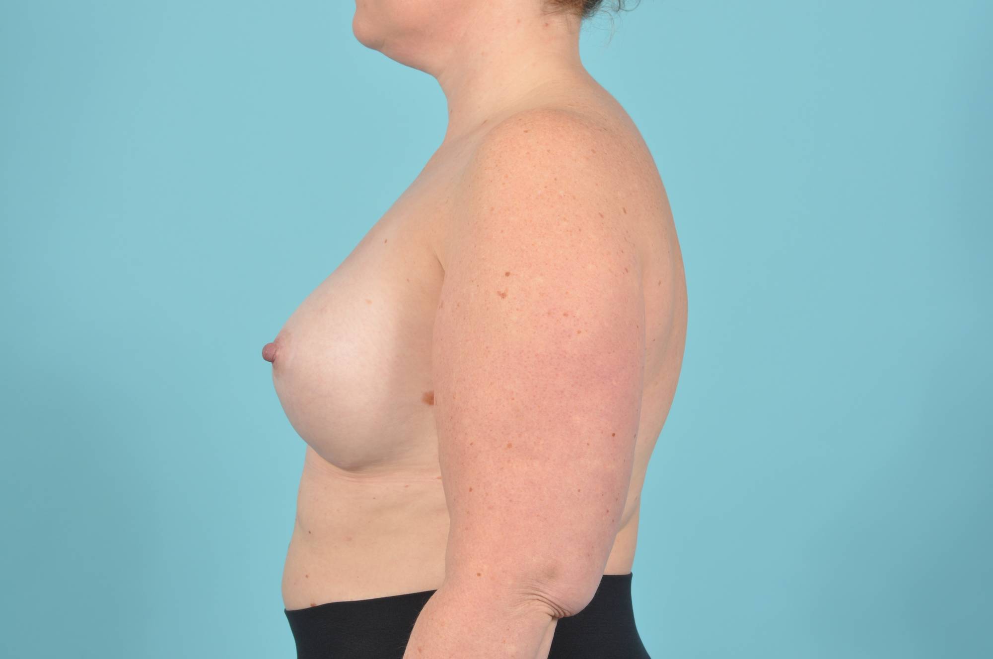 Breast Augmentation Before & After Image