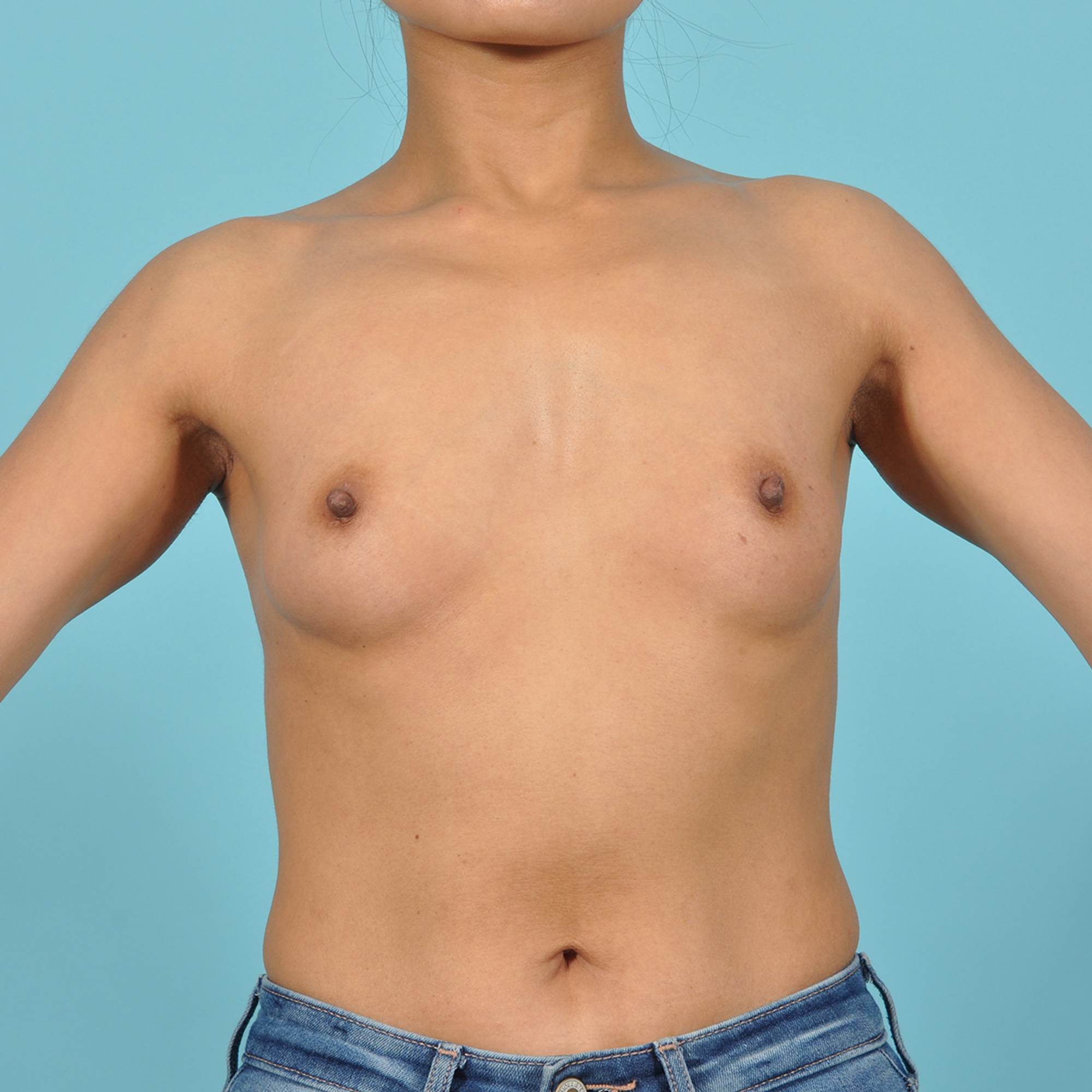 Breast Augmentation Before & After Image