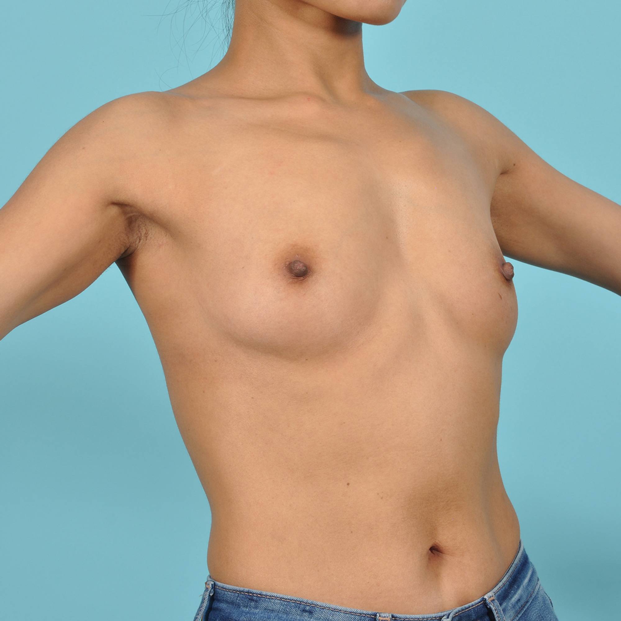 Breast Augmentation Before & After Image
